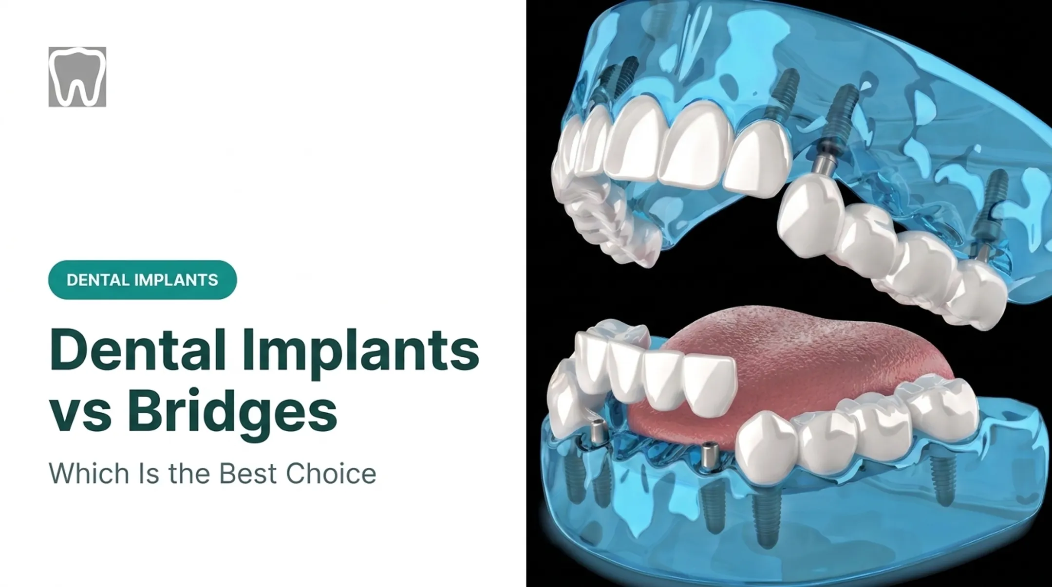 Dental Implants vs Bridges: Which Is the Best Choice