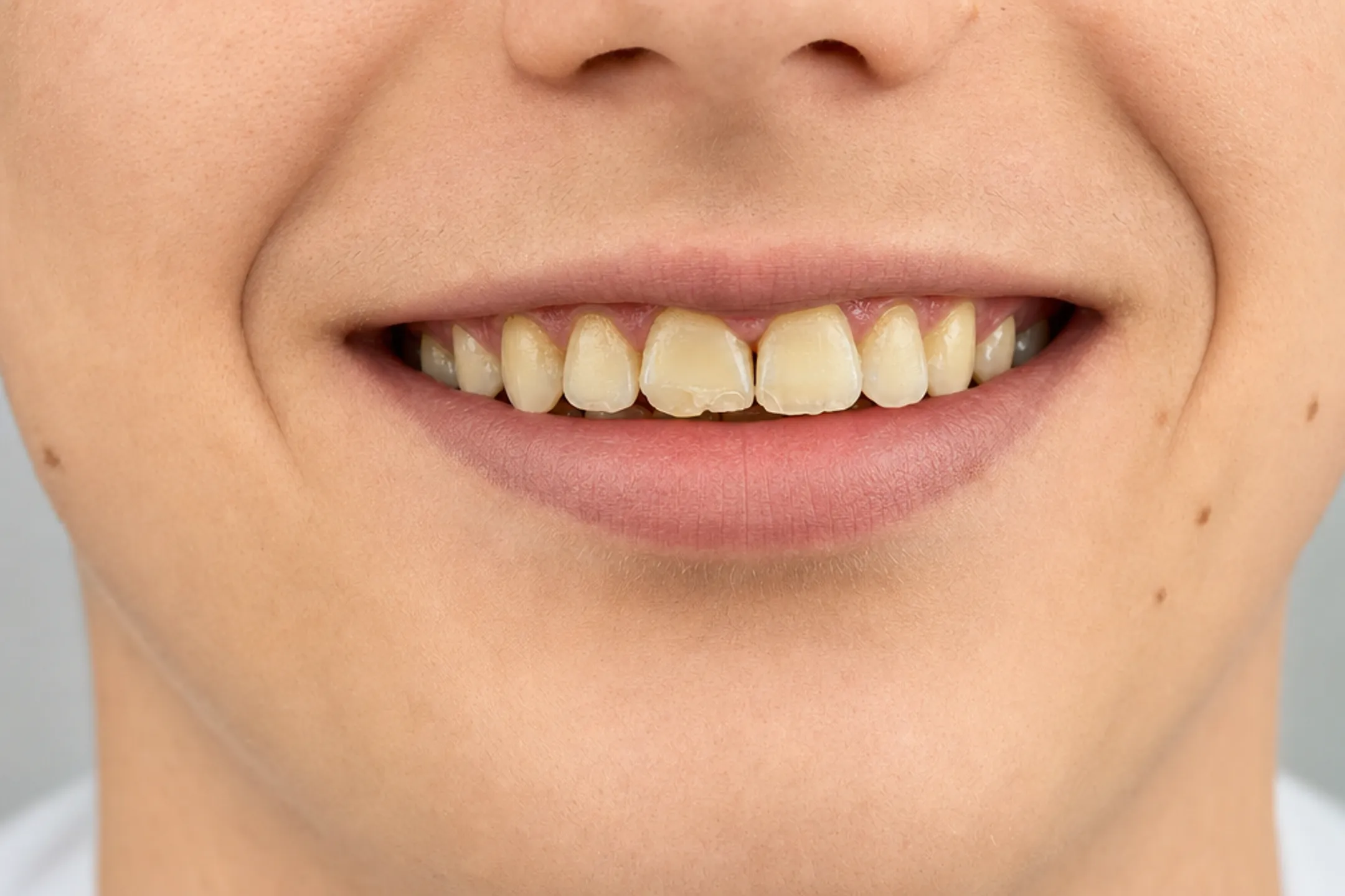 Close-up smile showing natural front teeth before veneer placement
