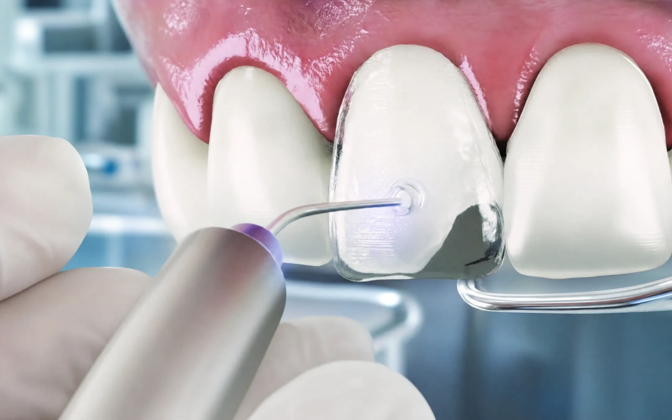Dentist bonding porcelain veneer onto patient front tooth in clinic