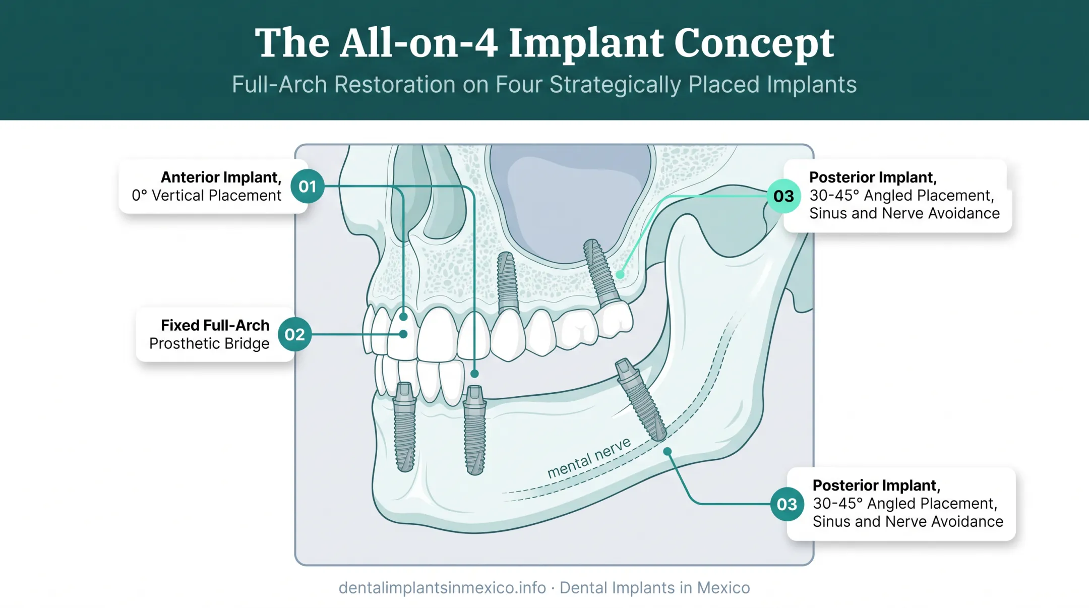 All-on-4 dental implant placement diagram showing angled posterior implants