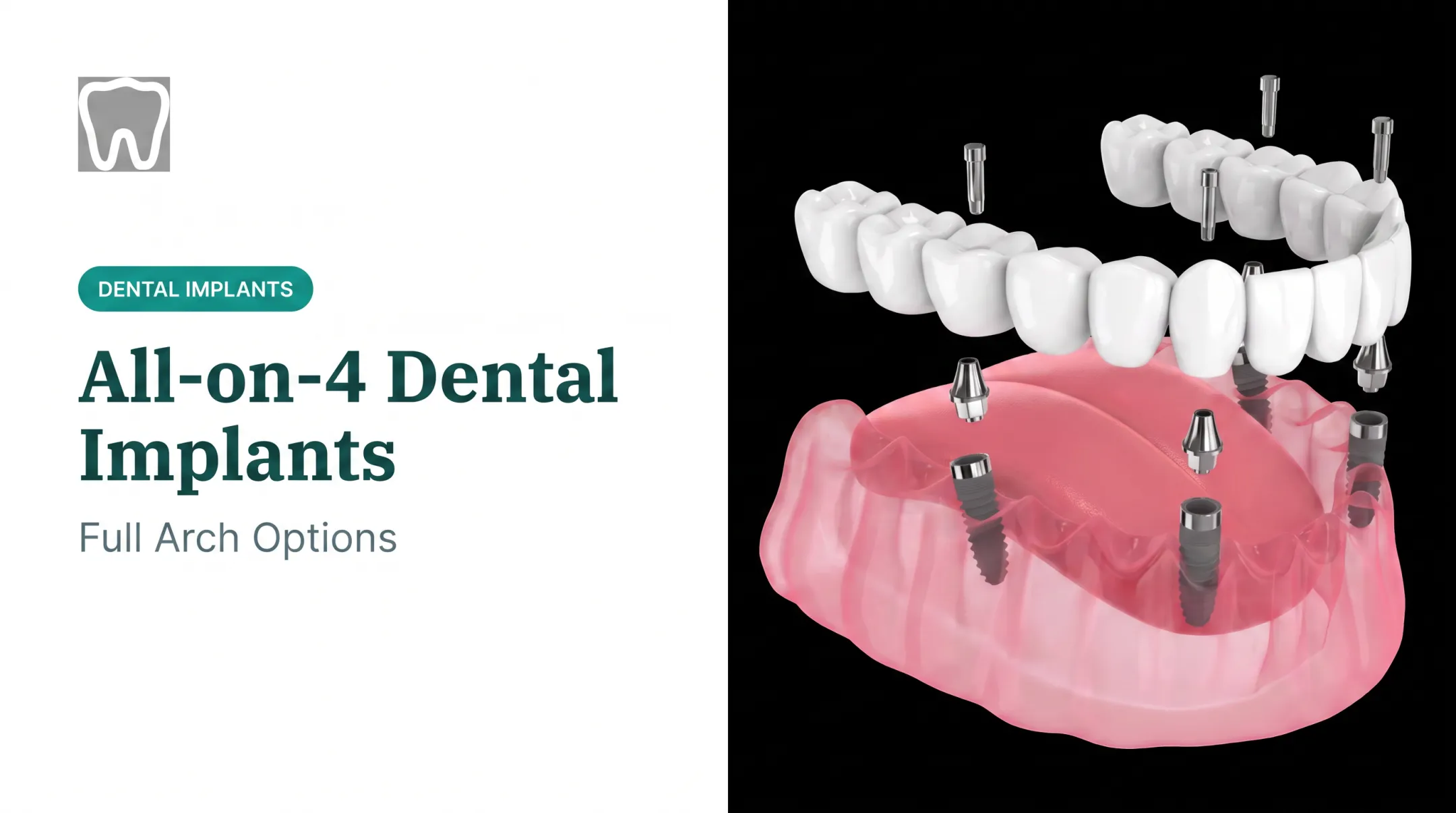 All-on-4 Dental Implants: Full Arch Options
