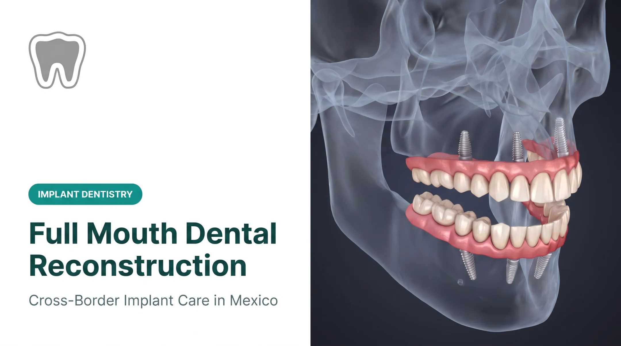 Full Mouth Dental Reconstruction
