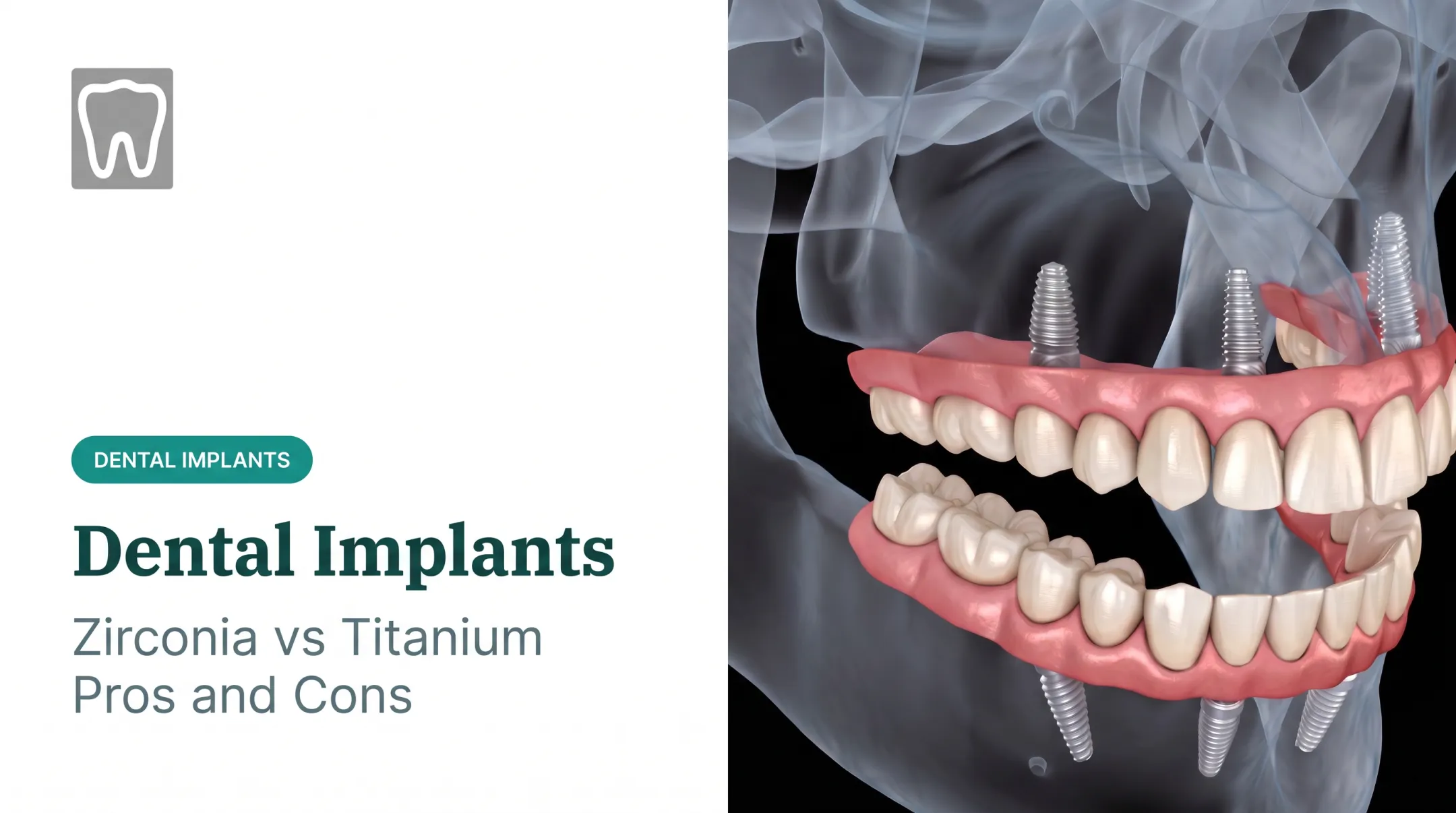 Dental Implants: Zirconia vs Titanium Pros and Cons