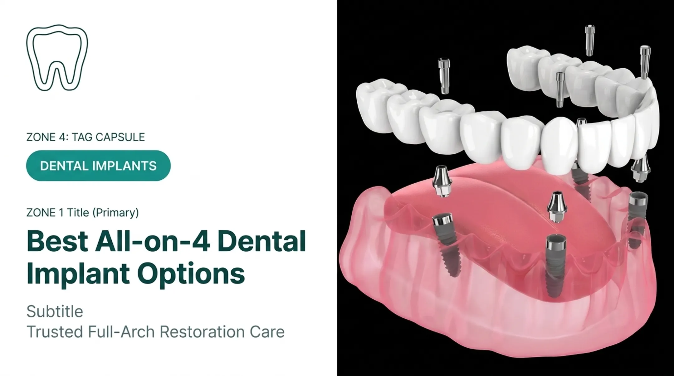 Best All-on-4 Dental Implant Options
