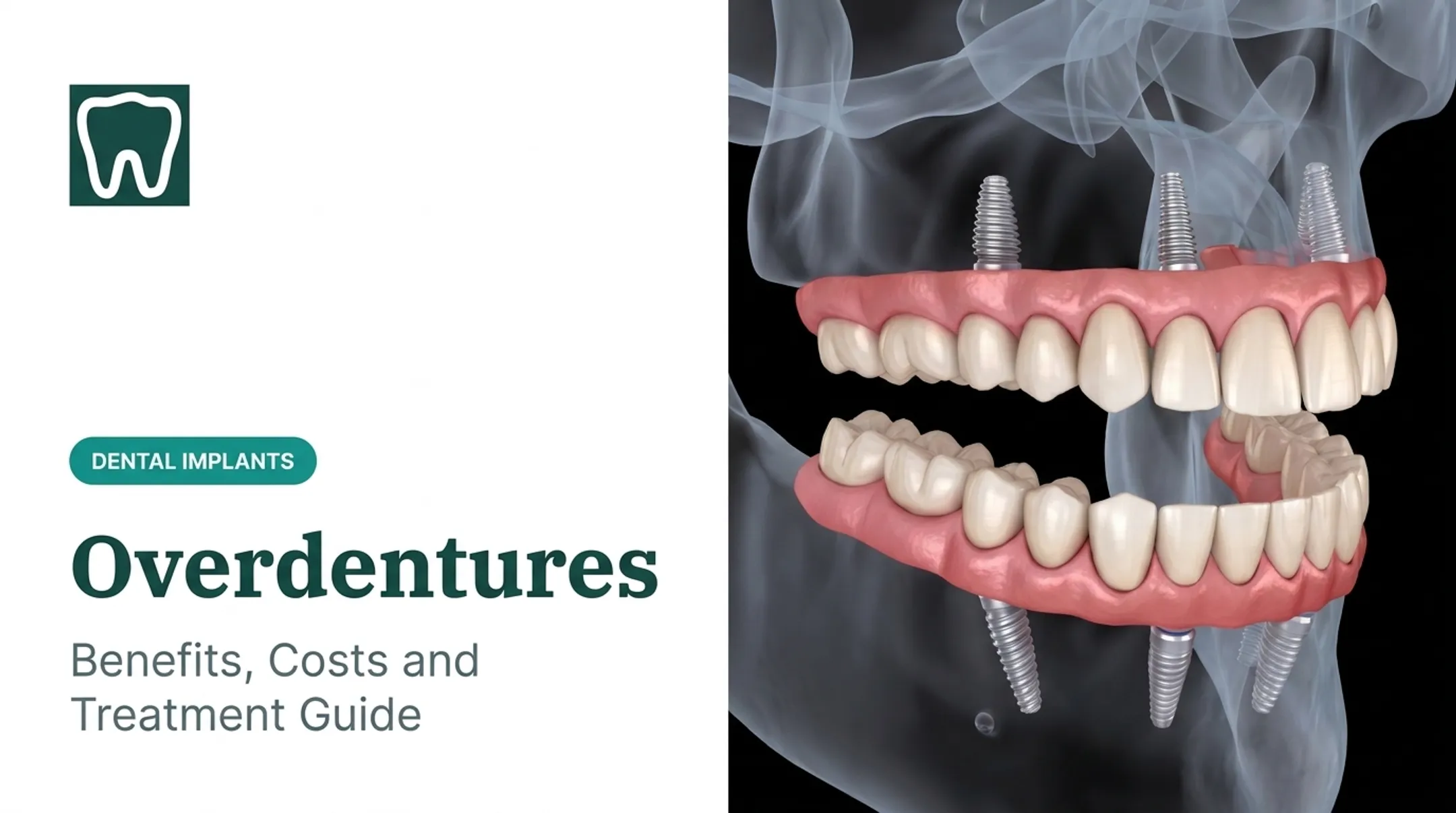 Overdentures: Benefits, Costs and Treatment Guide