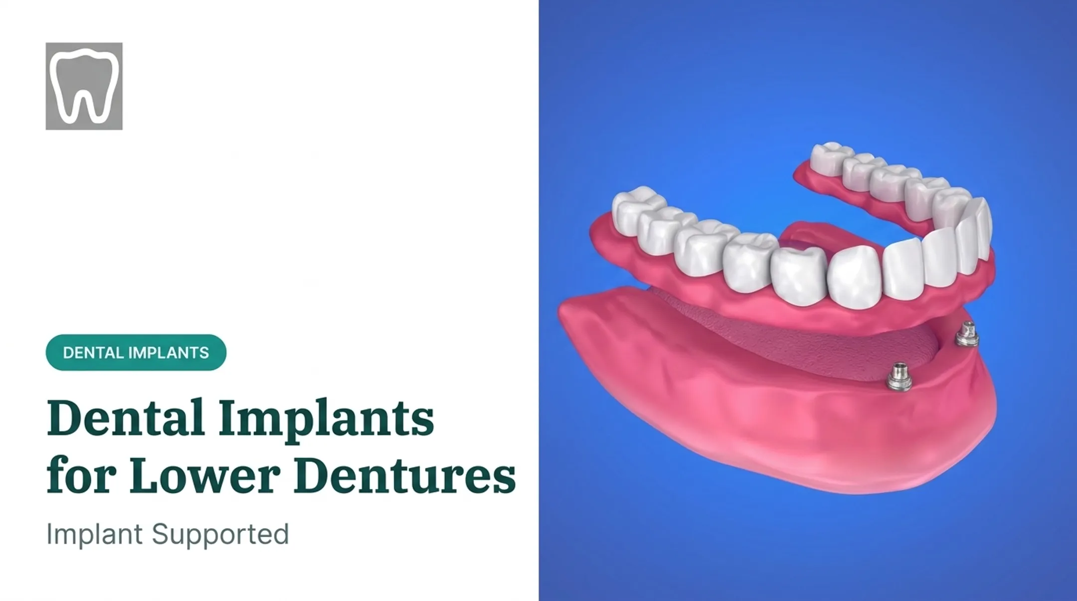 Dental Implants for Lower Dentures: Implant Supported