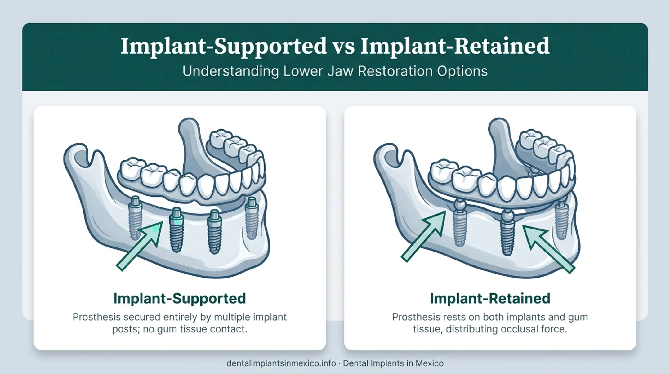 Implant-supported versus implant-retained lower denture attachment comparison diagram