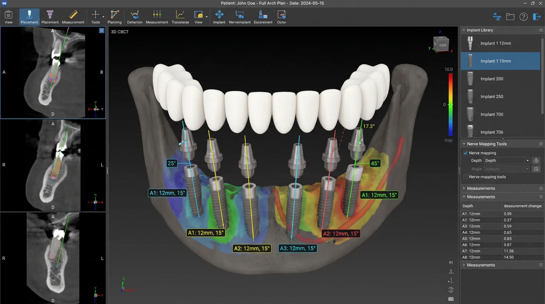 Digital surgical guide mapping implant position depth and angle