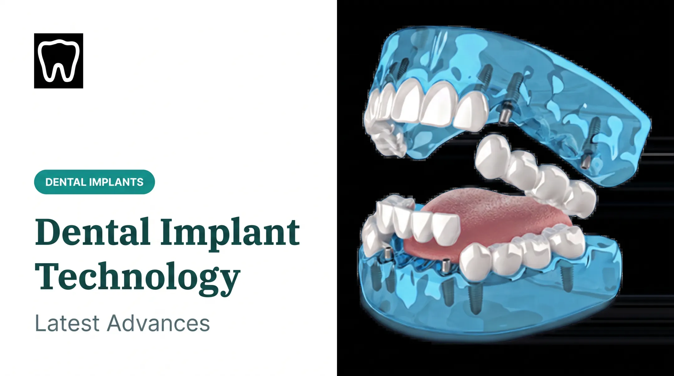 Dental Implant Technology: Latest Advances