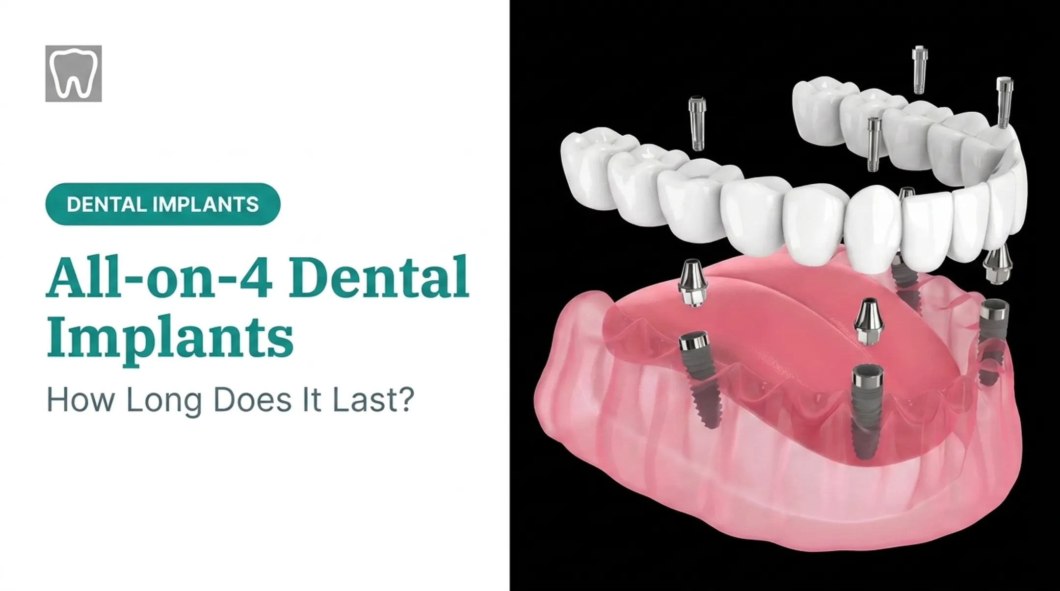 All-on-4 Dental Implants: How Long Does It Last?