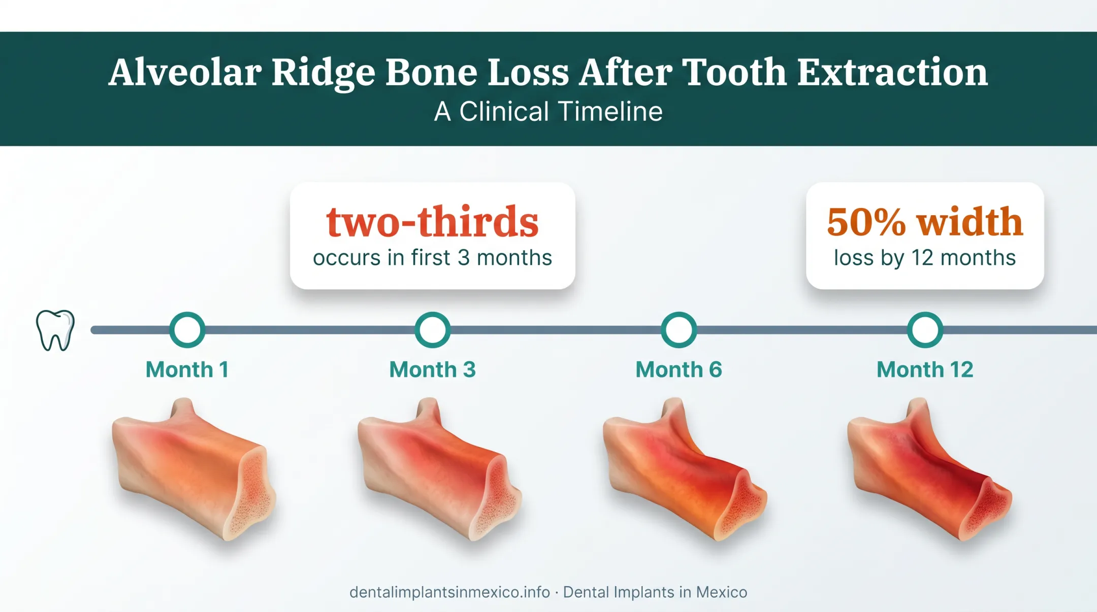 Jaw bone resorption timeline showing 50 percent loss in first year