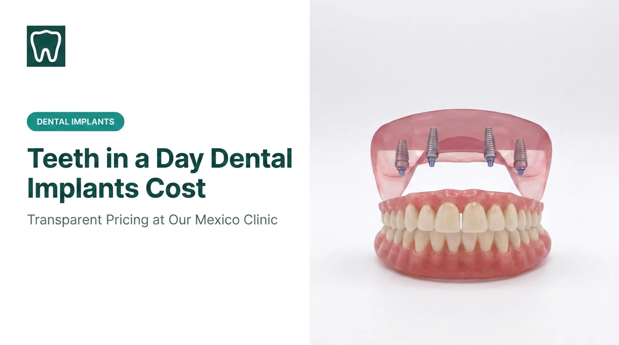 Teeth in a Day Dental Implants Cost
