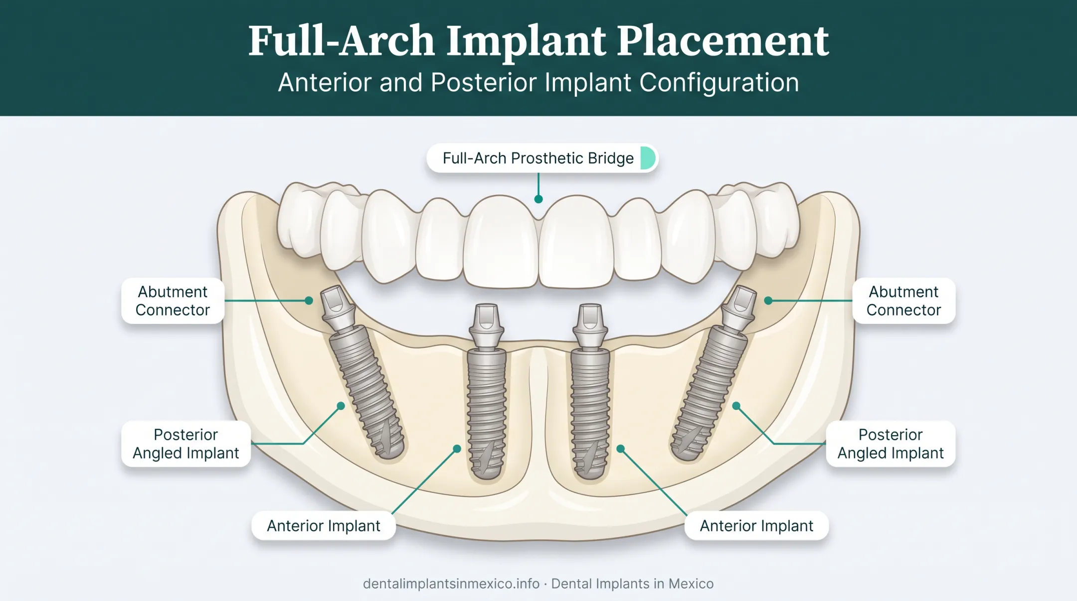 All-on-4 dental implant placement diagram showing four implant positions