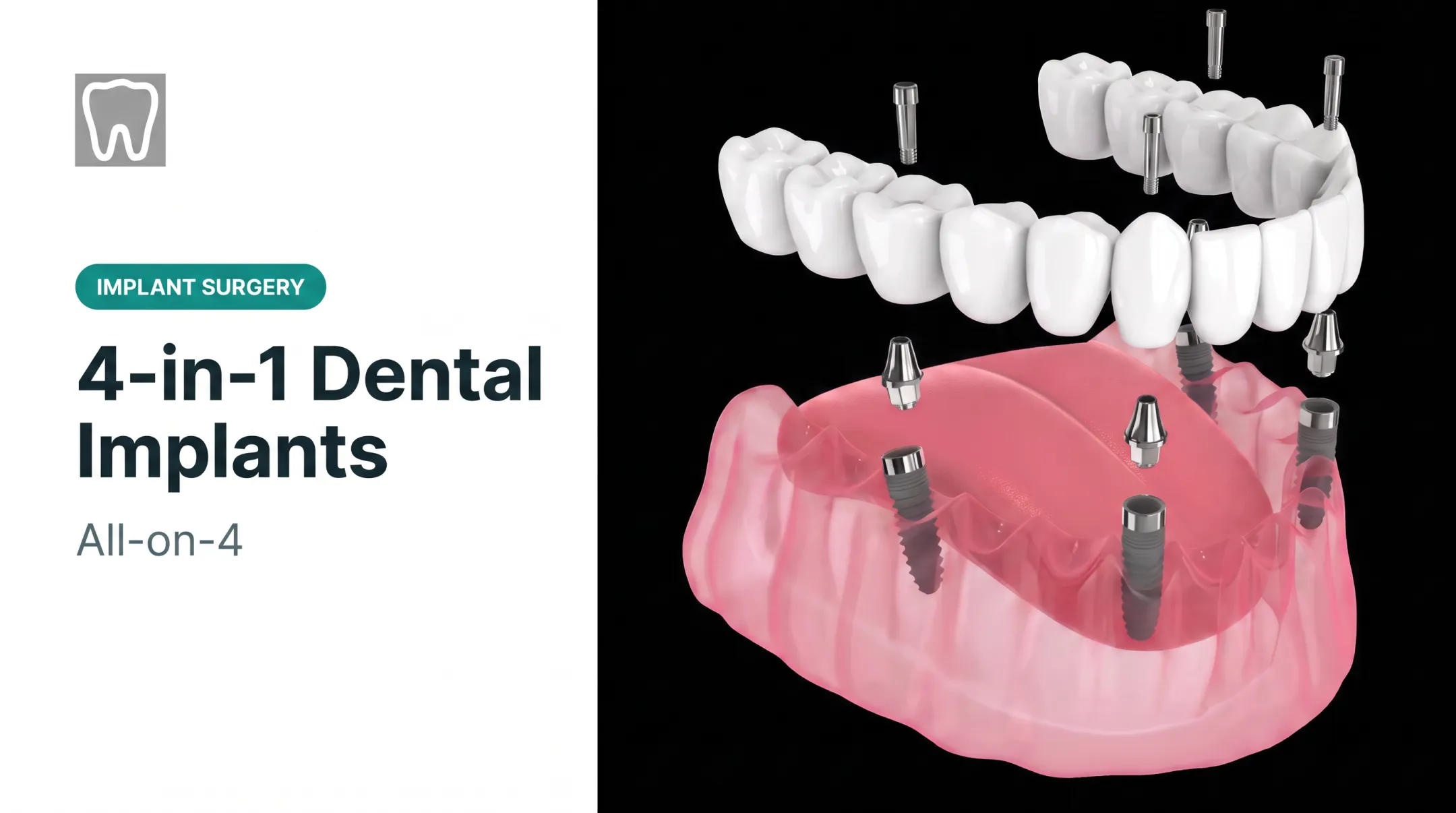 4-in-1 Dental Implants: All-on-4
