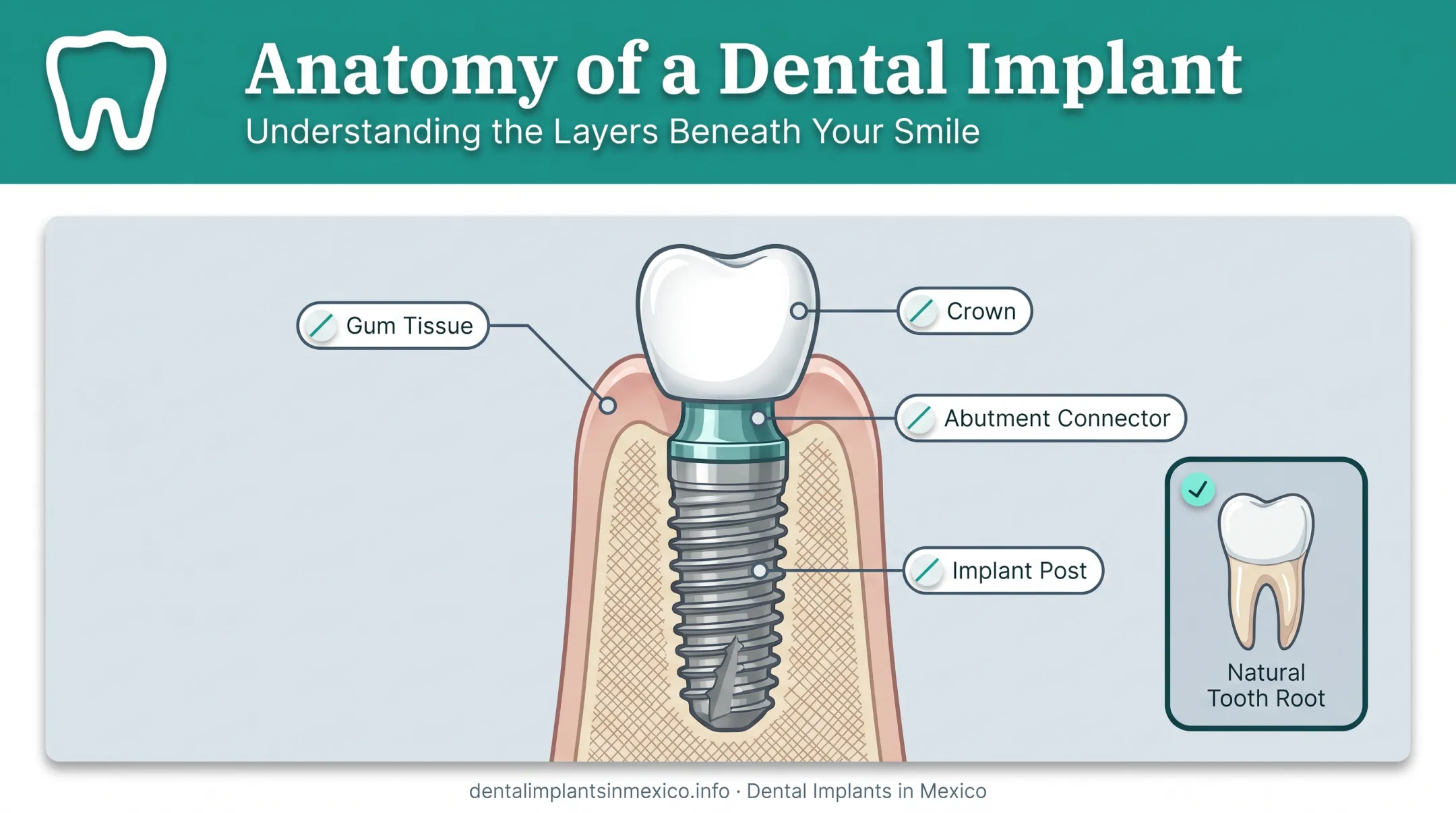 Dental implant anatomy showing post abutment and crown layers