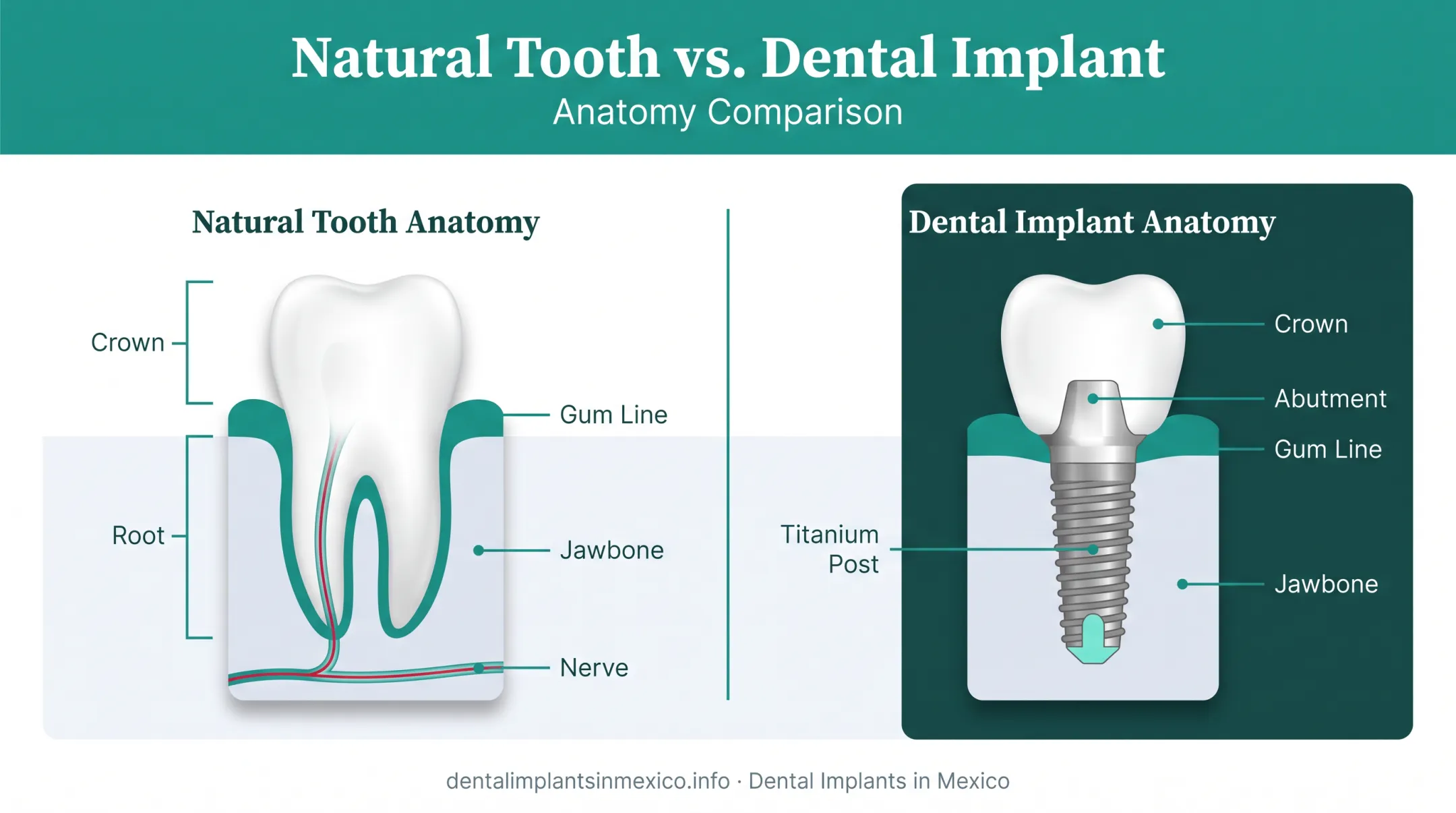 Dental implant anatomy showing titanium root post and crown structure