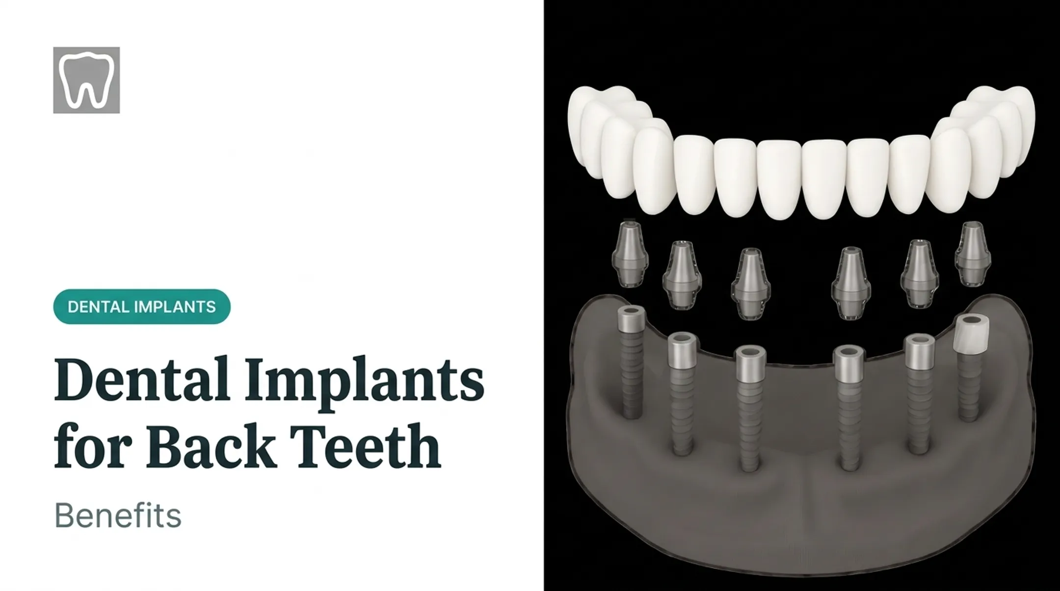 Dental Implants for Back Teeth: Benefits