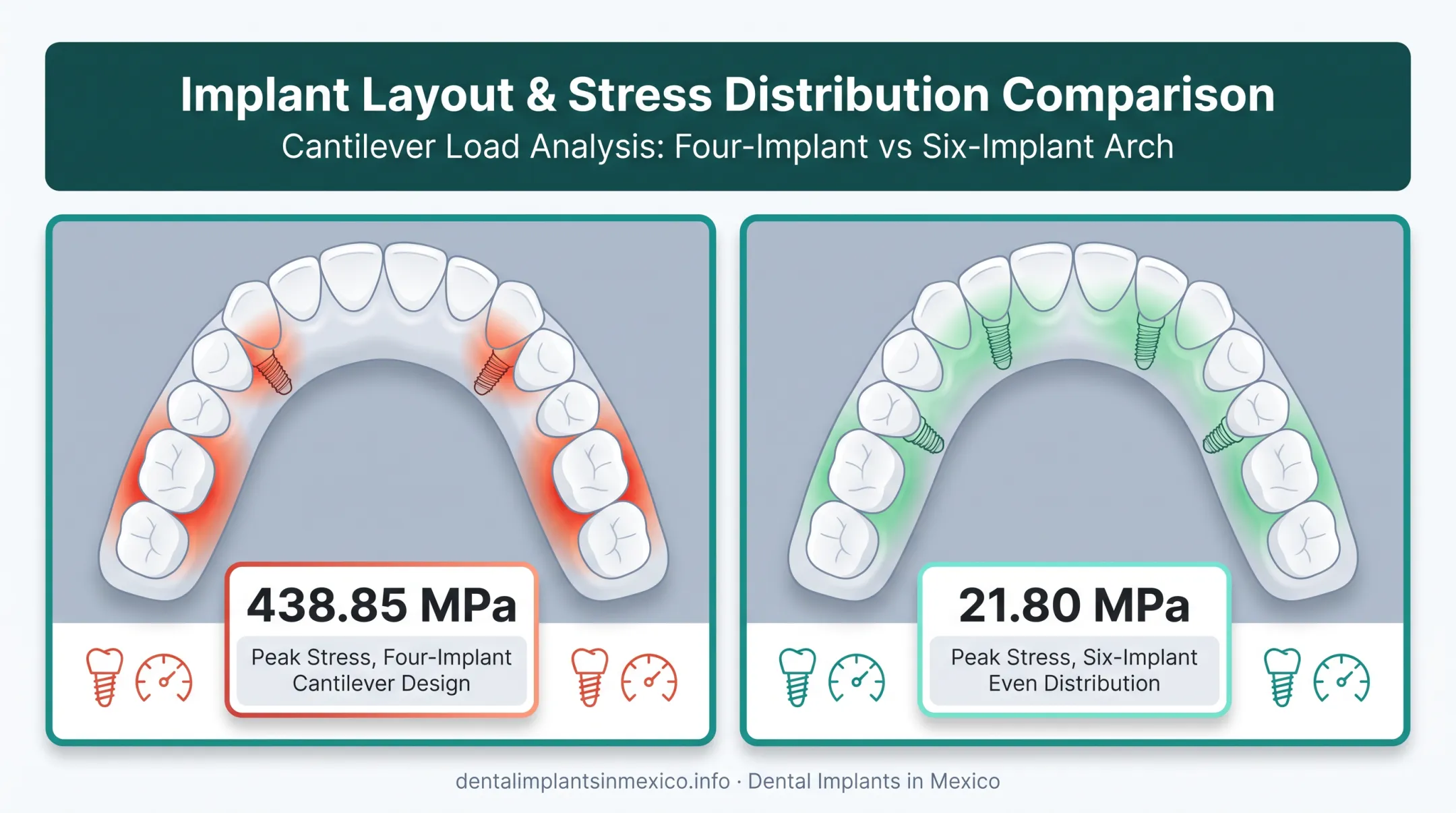 All-on-4 versus All-on-6 implant stress distribution comparison diagram