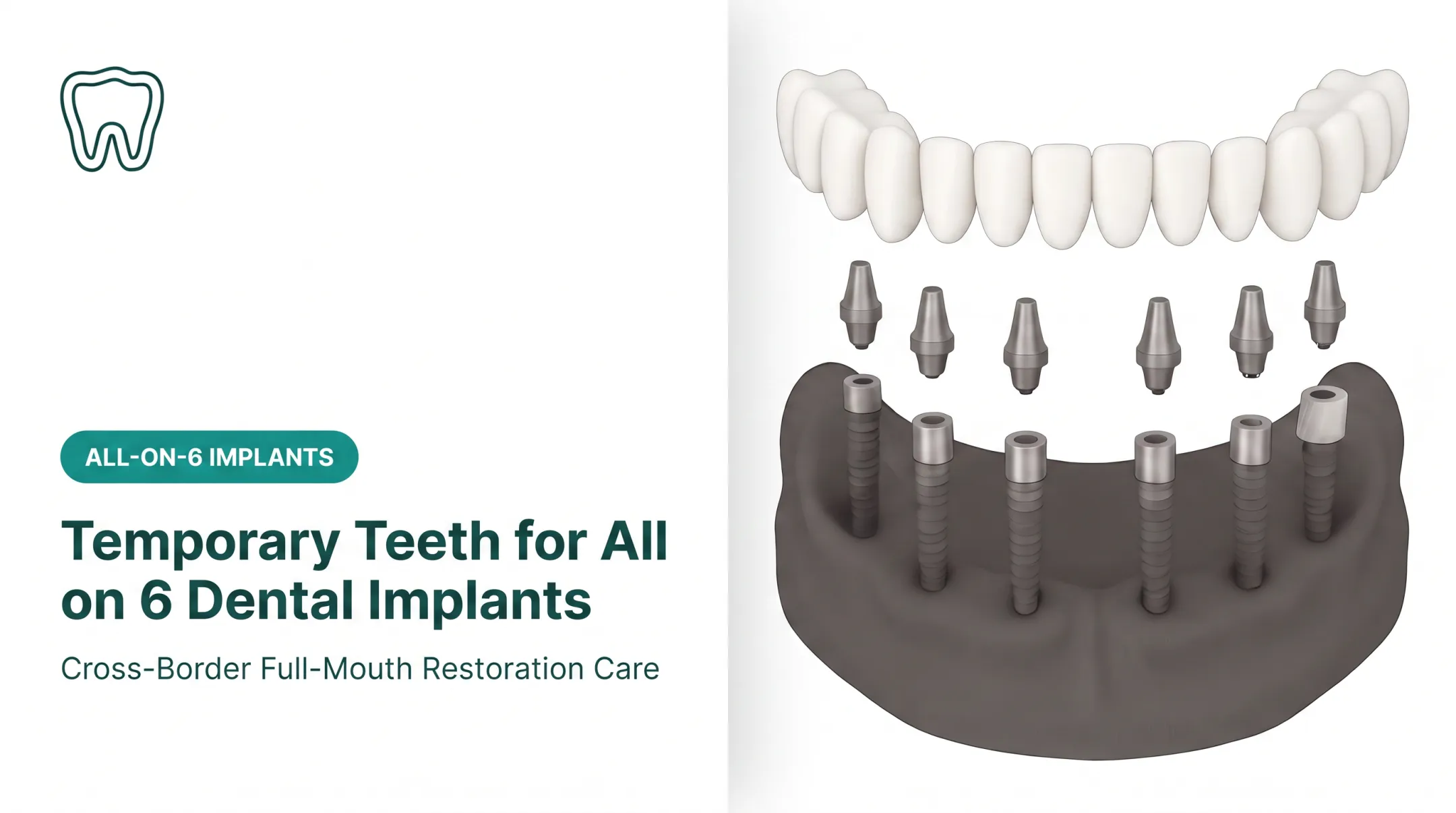 Temporary Teeth for All on 6 Dental Implants