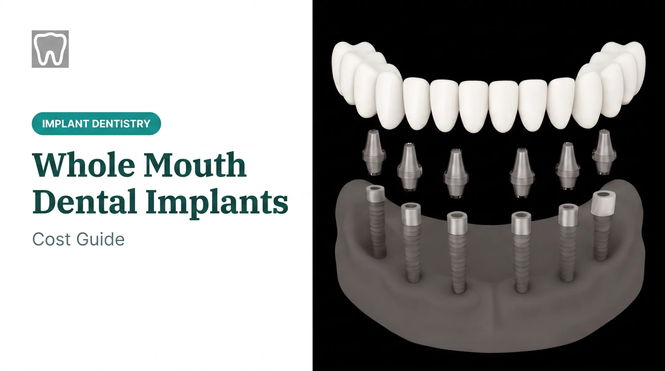 Whole Mouth Dental Implants: Cost Guide