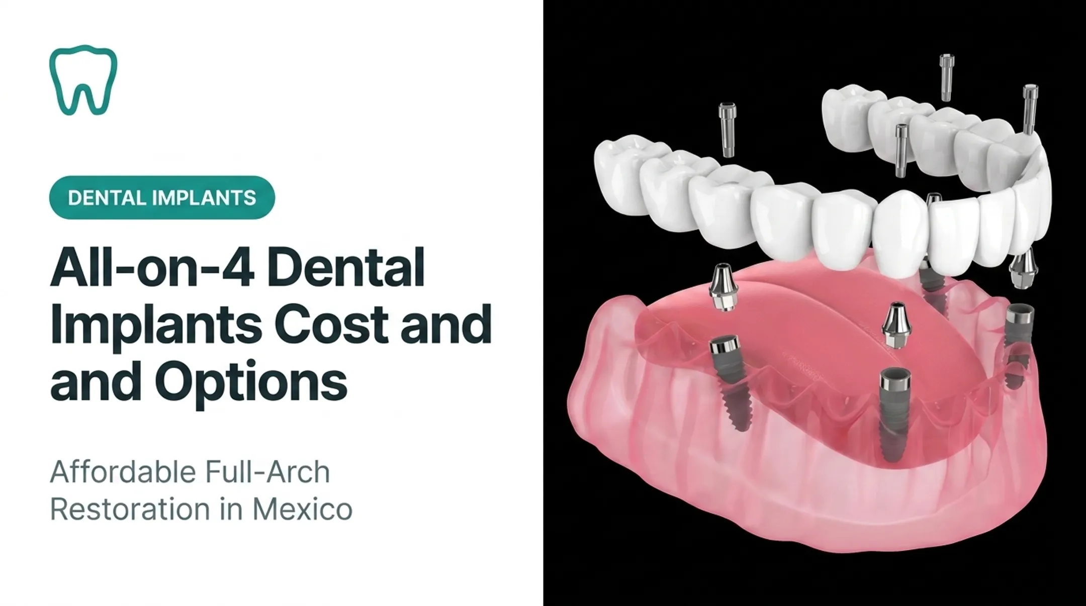 All-on-4 Dental Implants Cost and Options