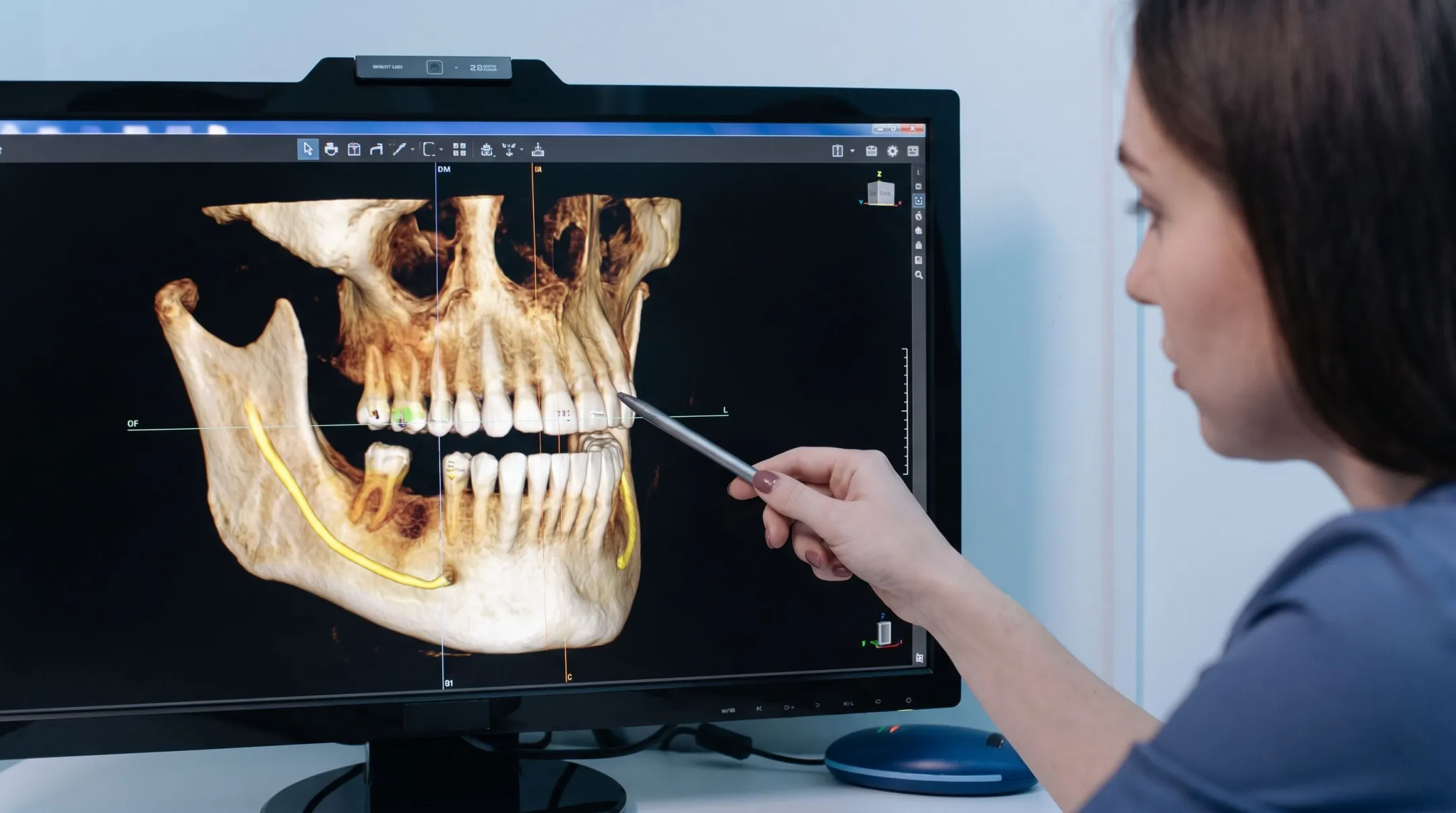 3D Cone Beam CT scan imaging used for dental implant planning