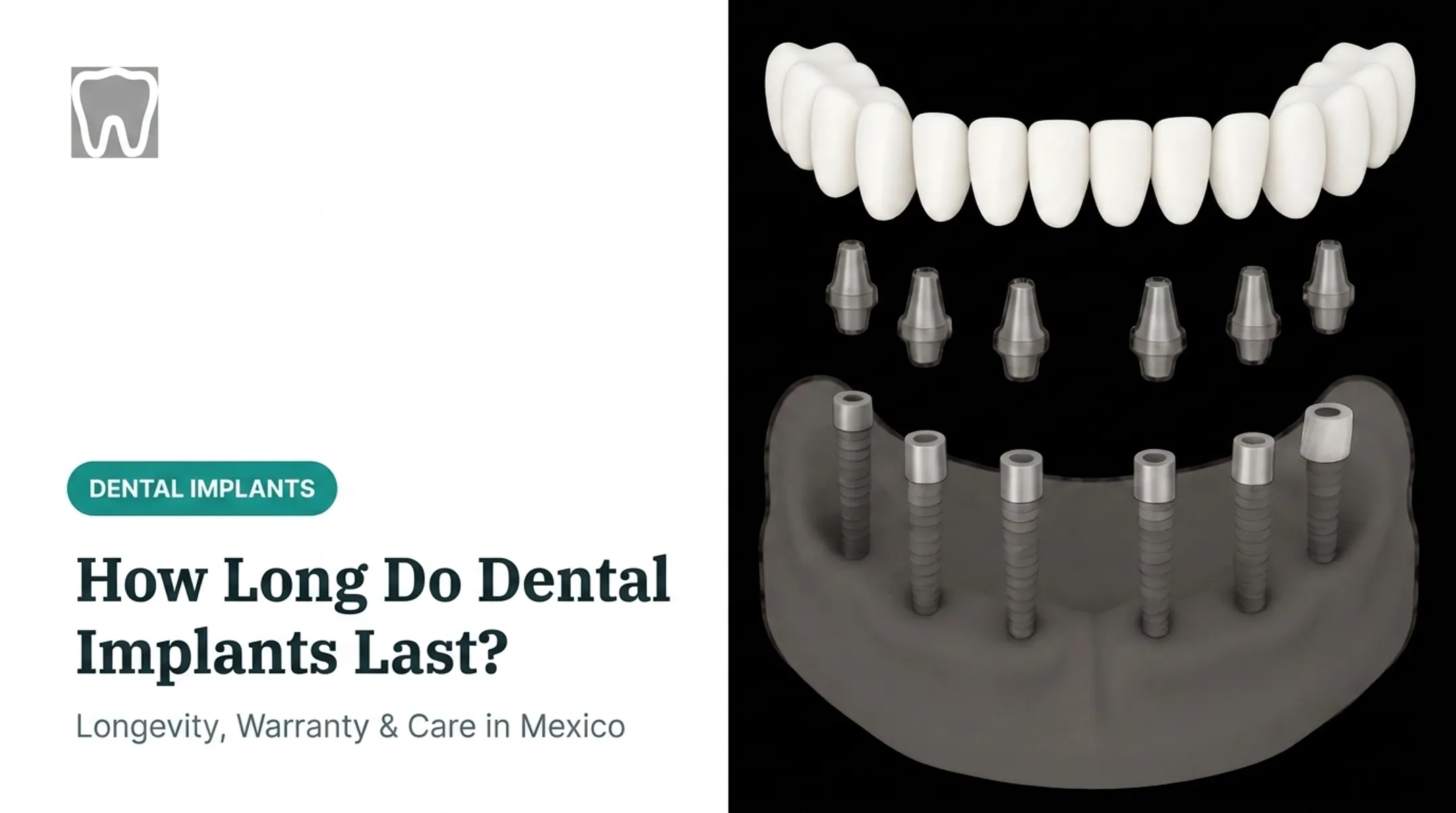 How Long Do Dental Implants Last?