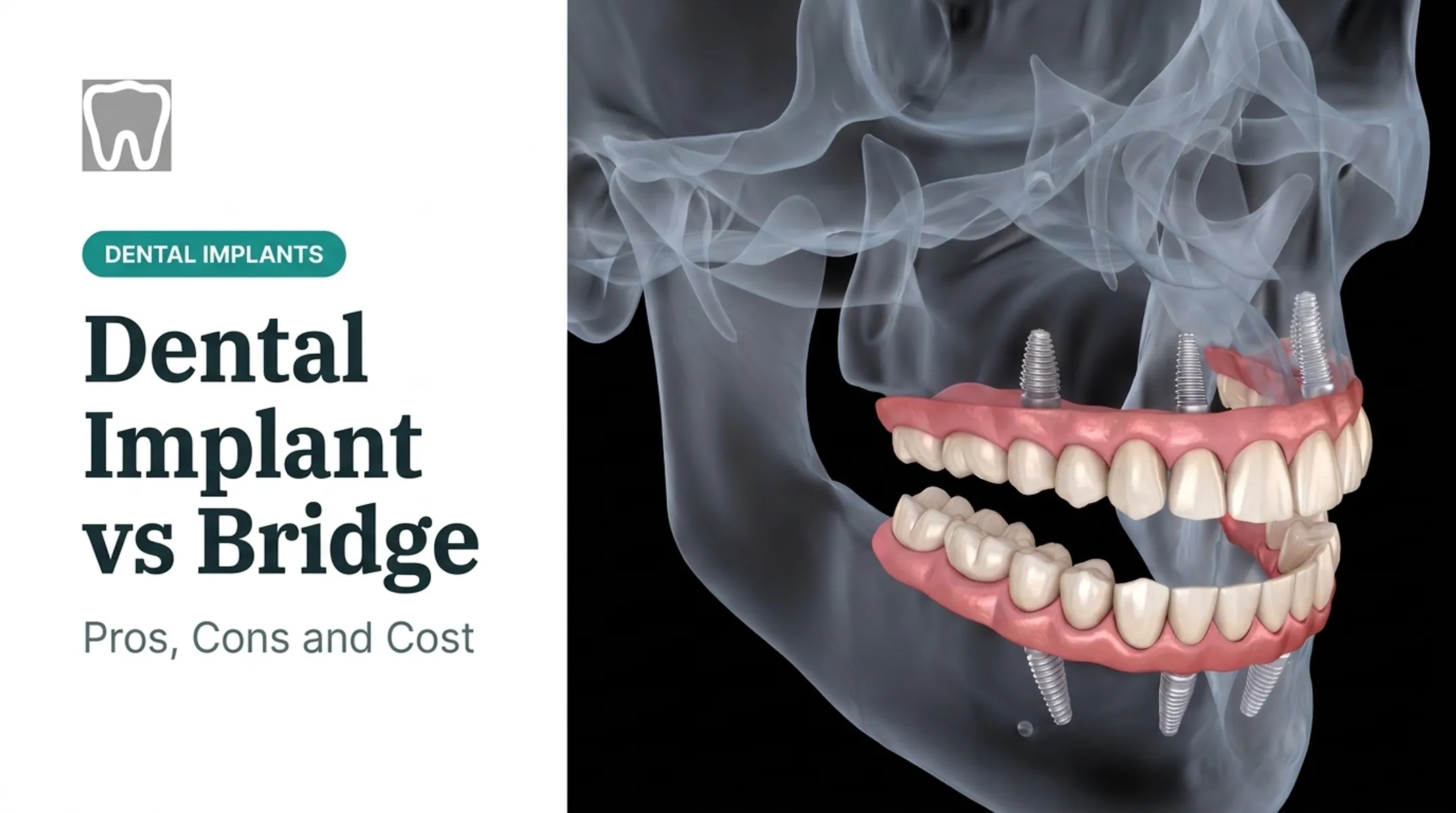 Dental Implant vs Bridge: Pros, Cons and Cost