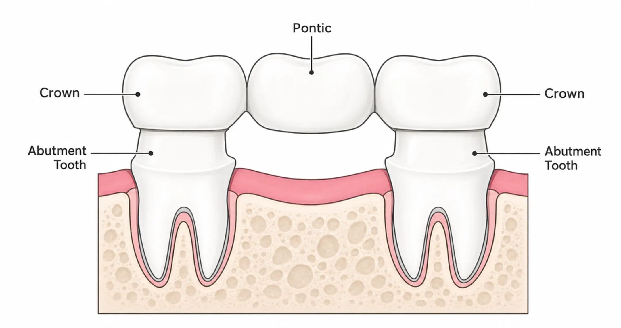 Traditional dental bridge with crowns on abutment teeth illustration