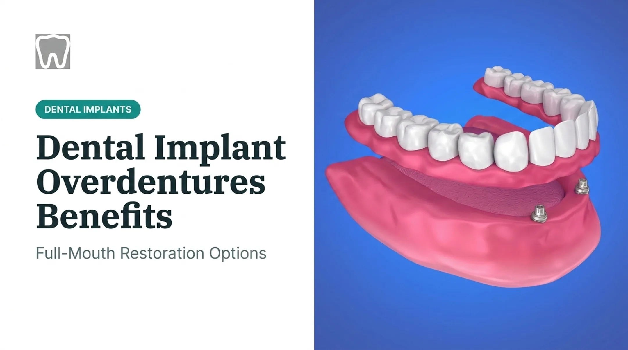 Dental Implant Overdentures Benefits