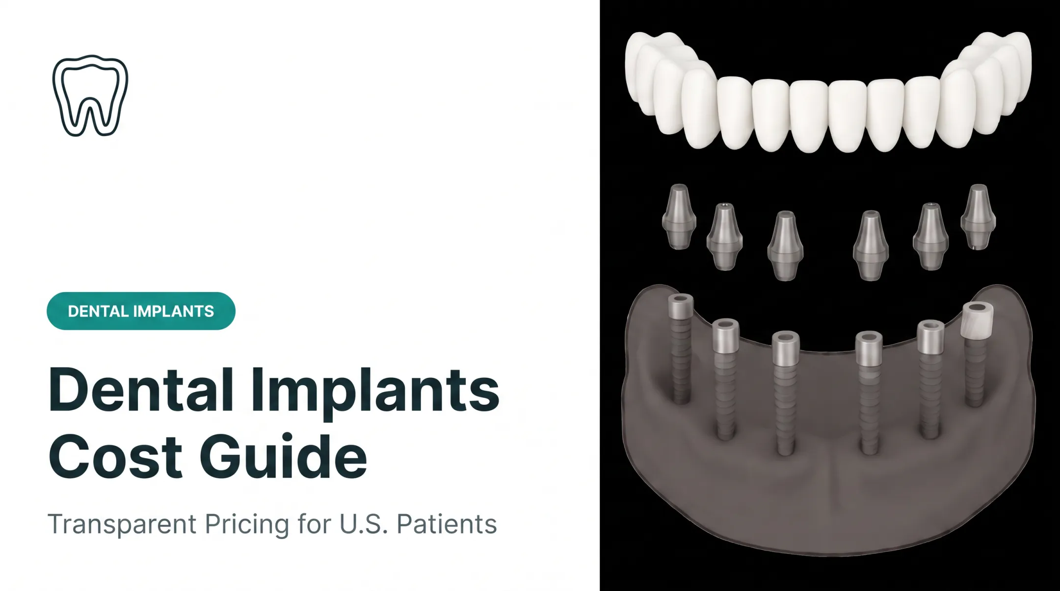 Dental Implants Cost Guide