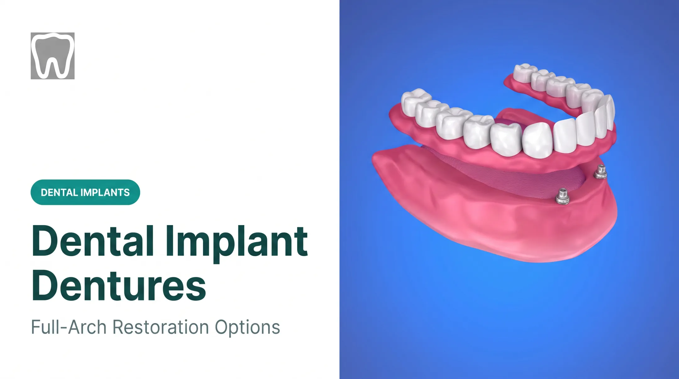 Dental Implant Dentures