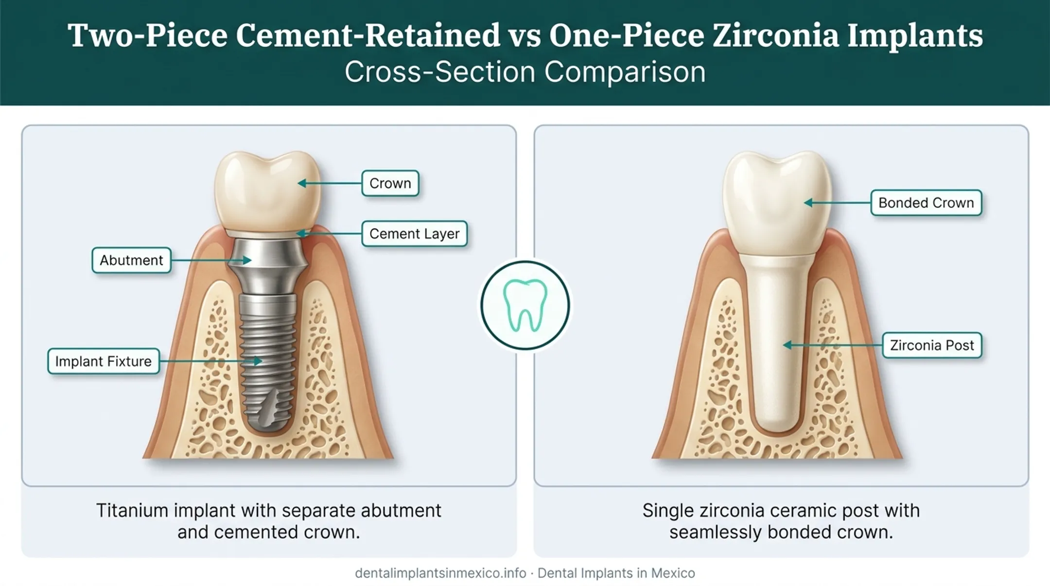 Cement-retained versus one-piece zirconia screwless implant structure diagram