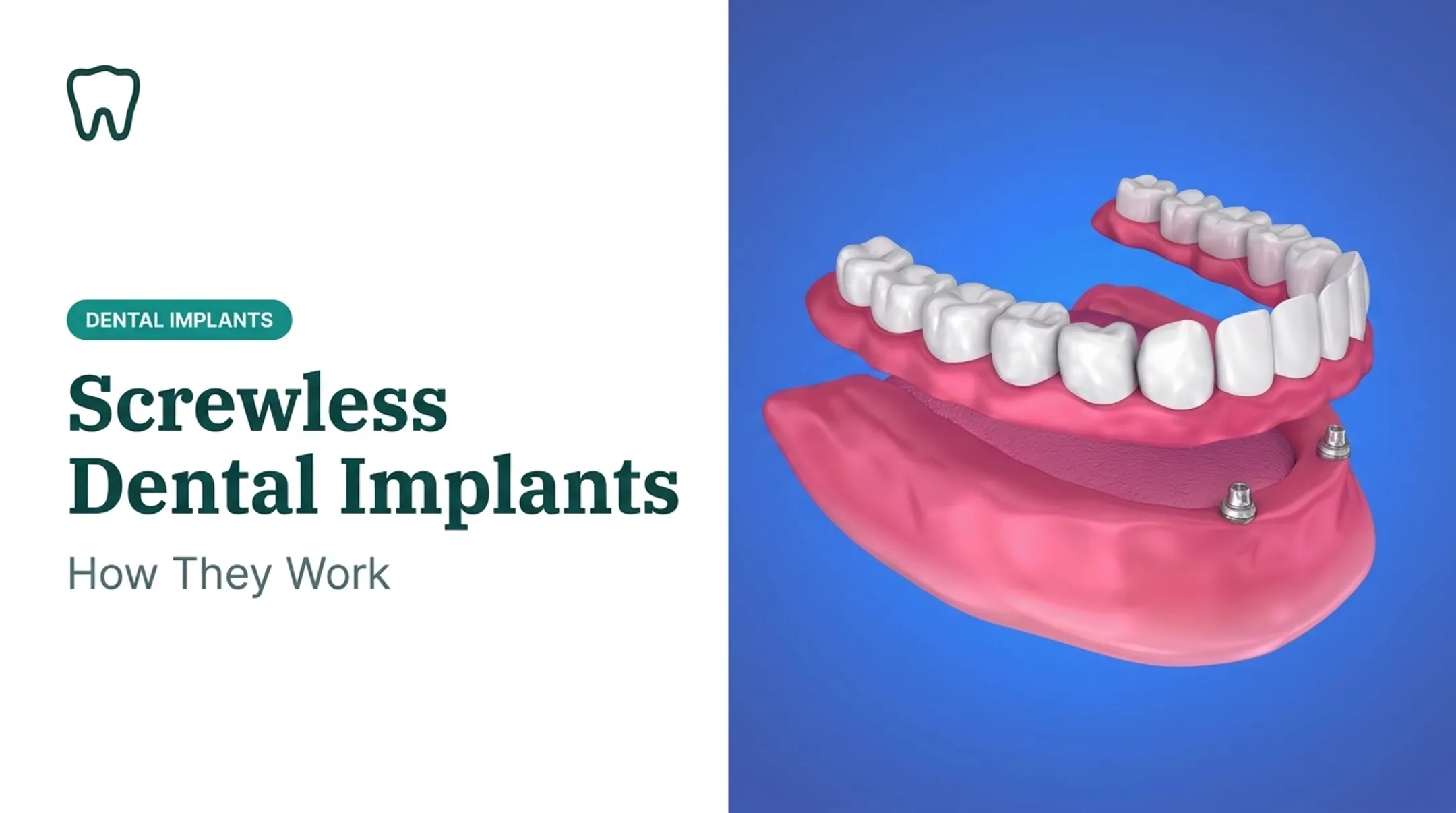 Screwless Dental Implants: How They Work