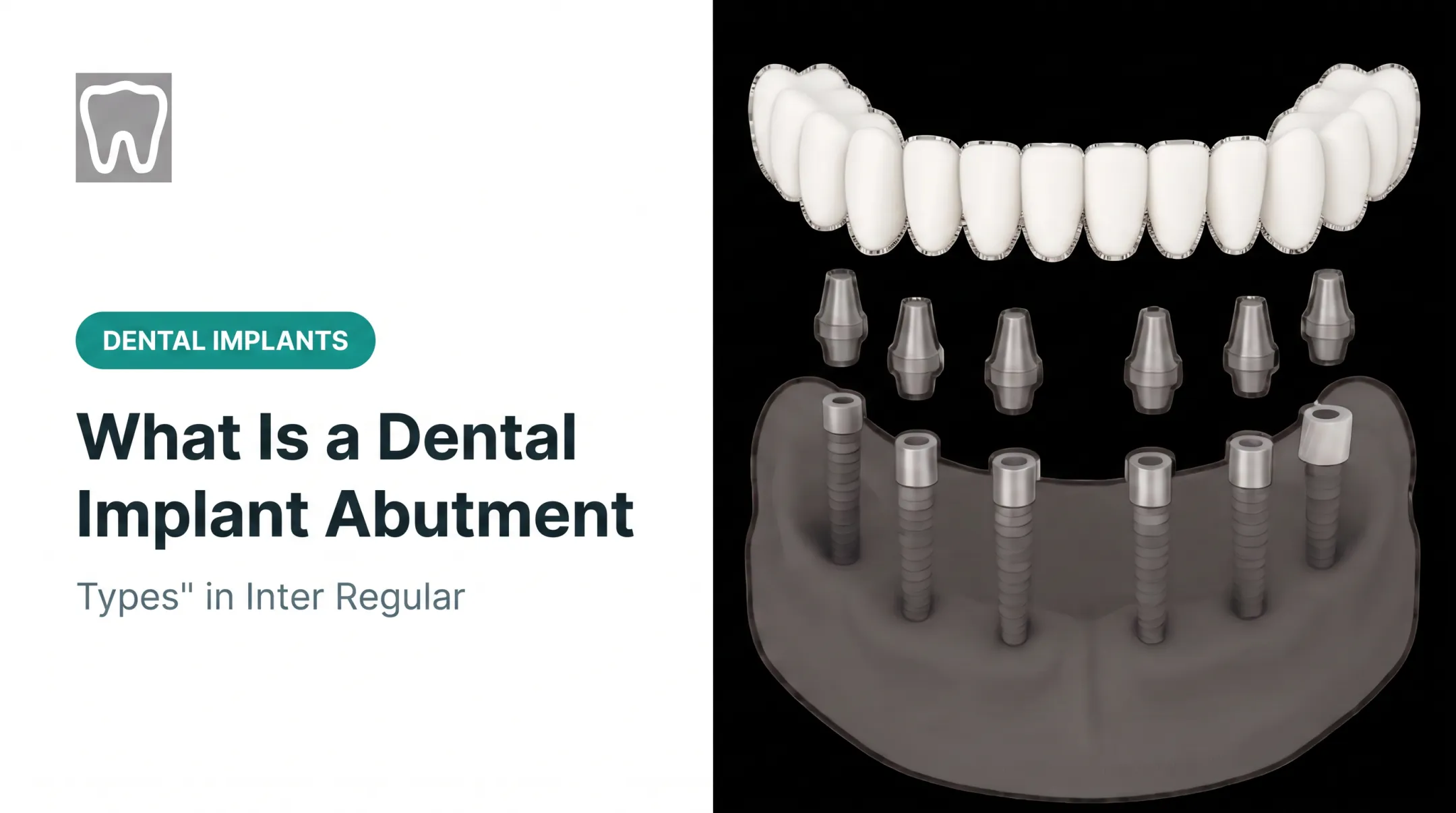 What Is a Dental Implant Abutment: Types