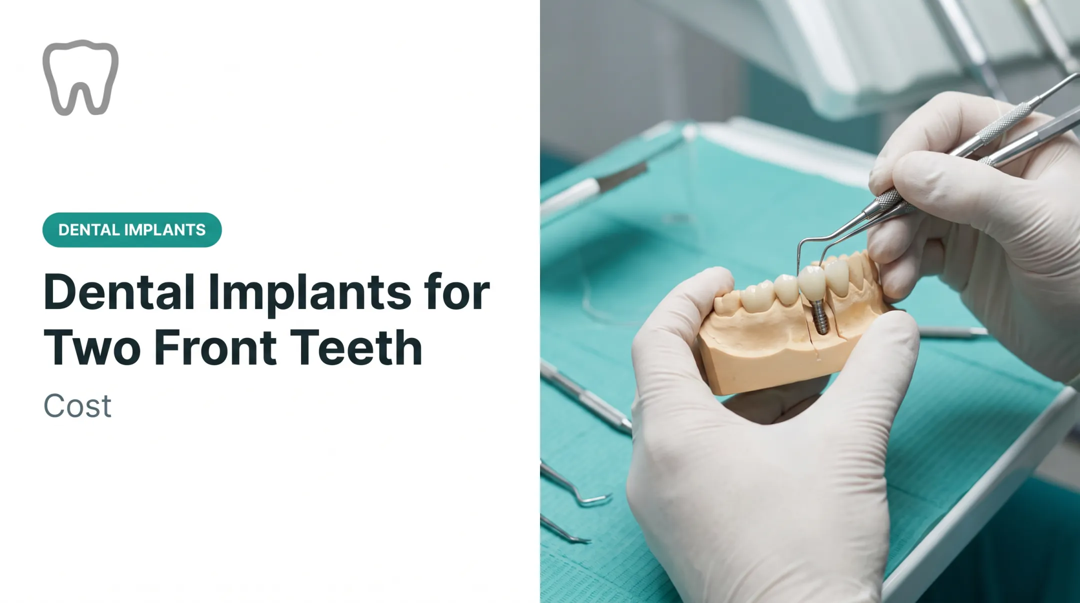 Dental Implants for Two Front Teeth: Cost