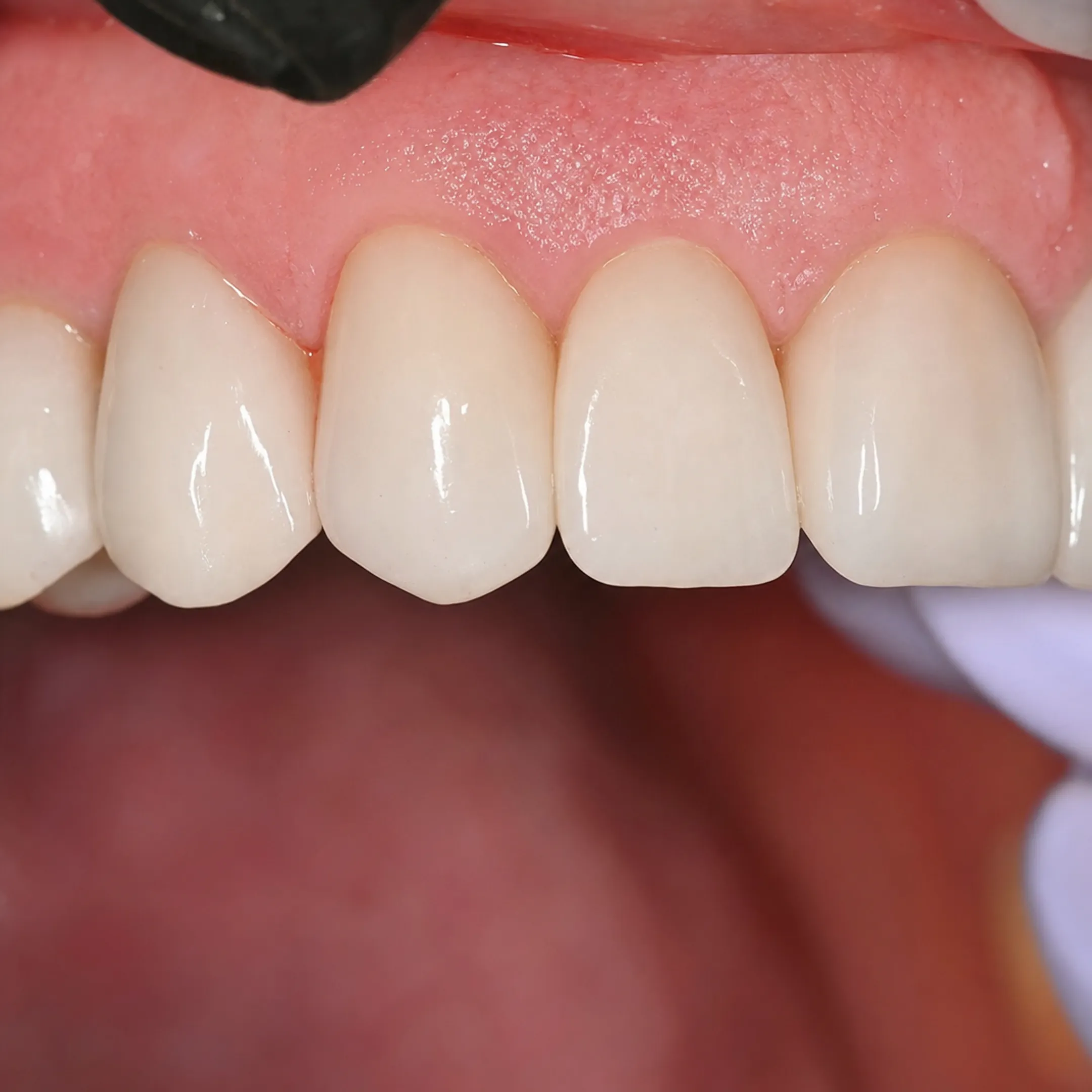 Natural looking front tooth implant crown with proper gum contouring