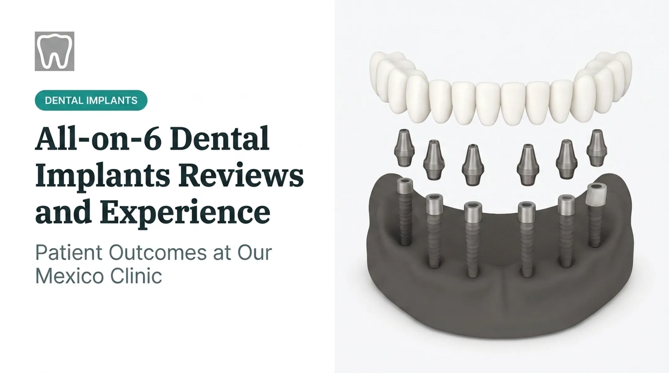 All-on-6 Dental Implants Reviews and Experience