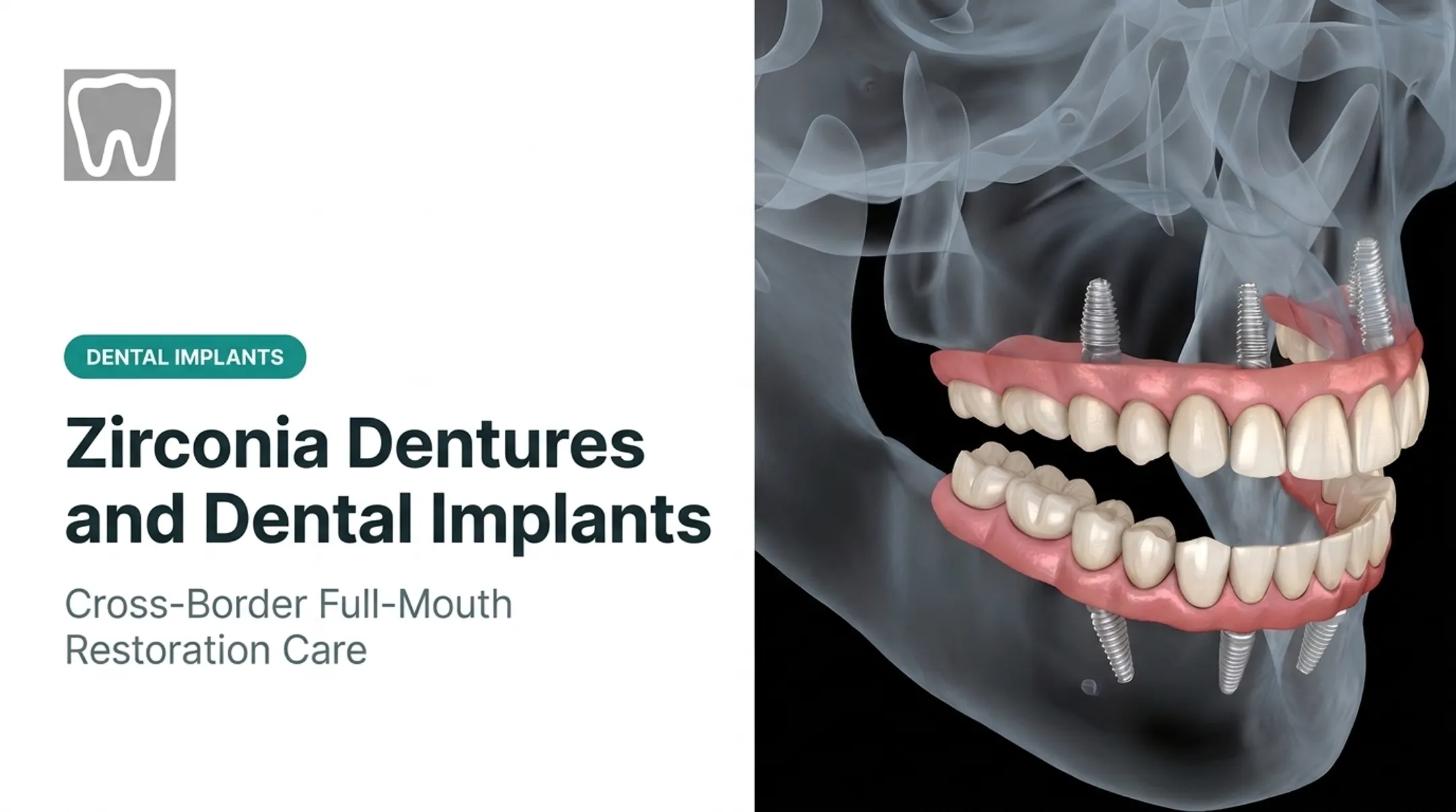 Zirconia Dentures and Dental Implants
