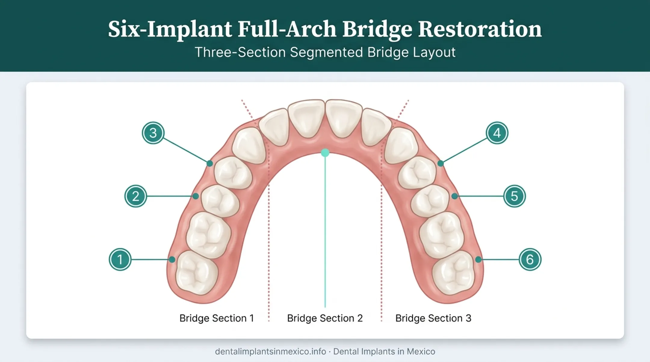 3-on-6 dental implant placement diagram showing six implants per arch