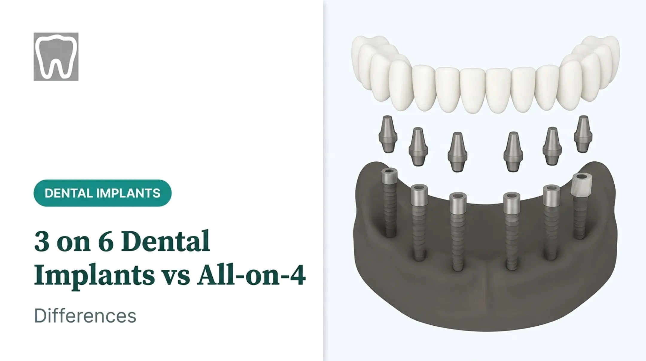 3 on 6 Dental Implants vs All-on-4: Differences