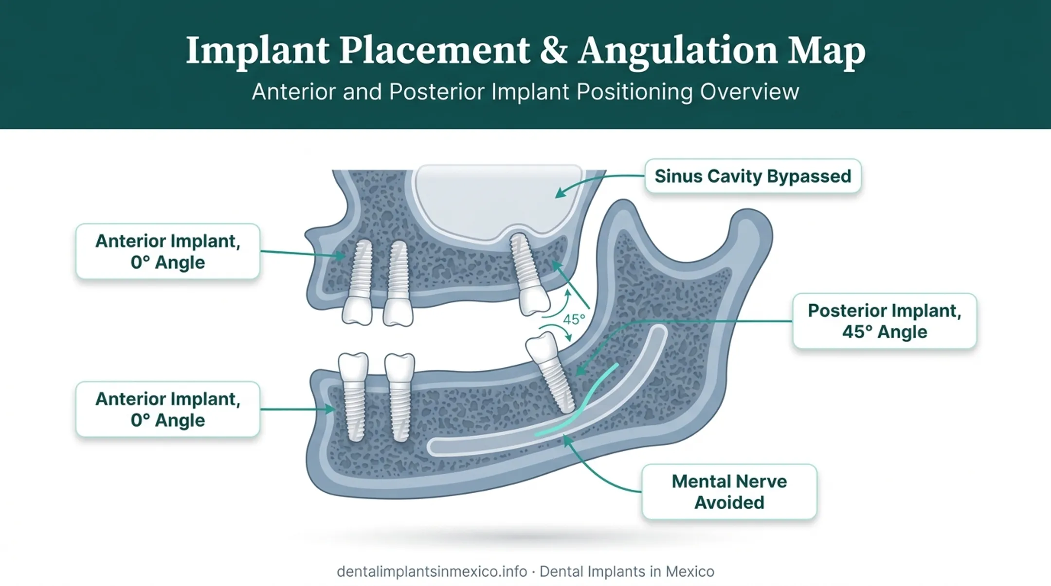 All-on-4 implant angulation diagram showing anterior and posterior placement
