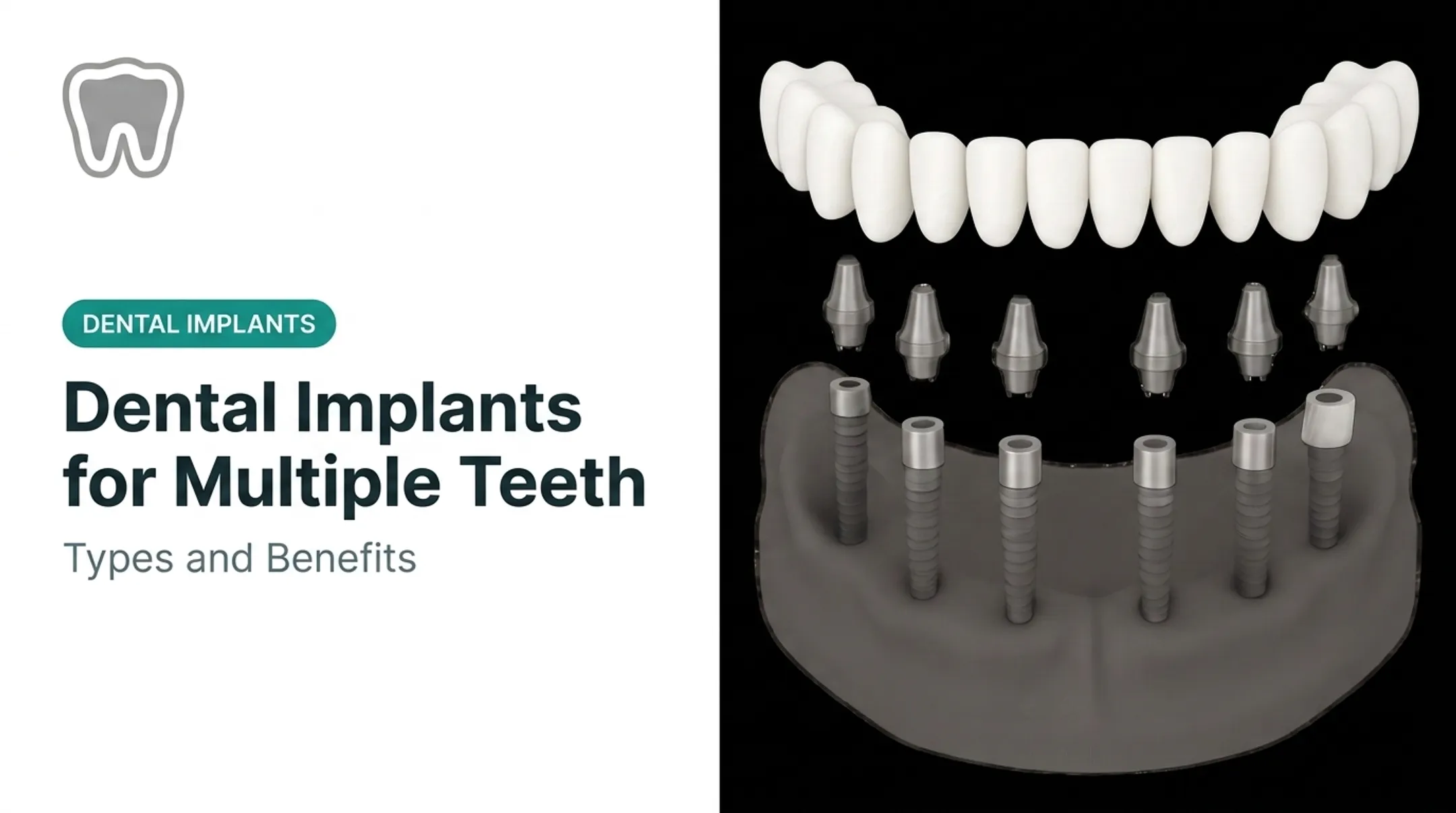 Dental Implants for Multiple Teeth: Types and Benefits