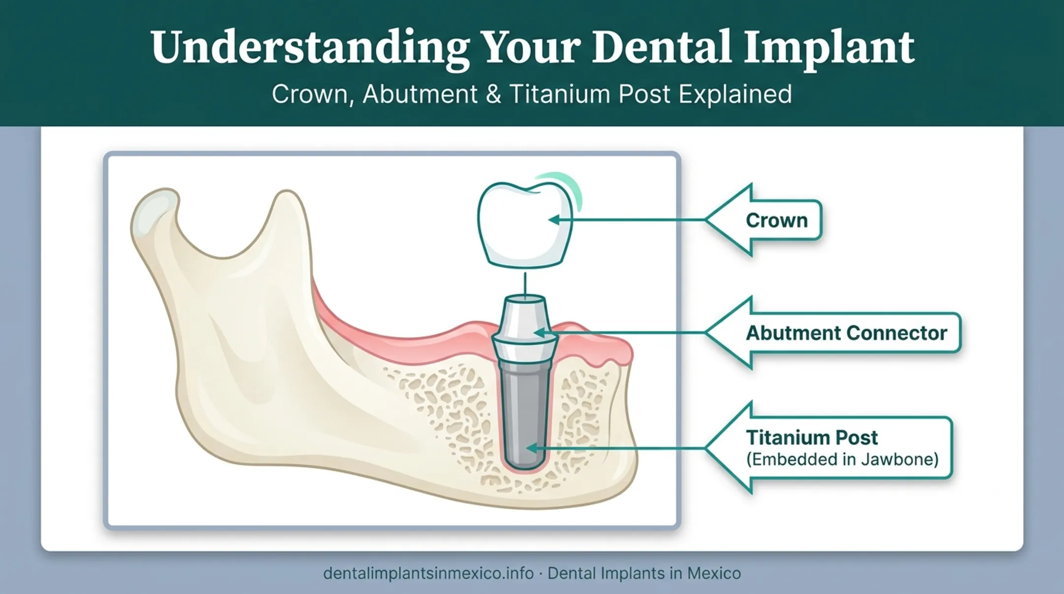 Endosteal implant anatomy showing titanium post abutment and crown layers