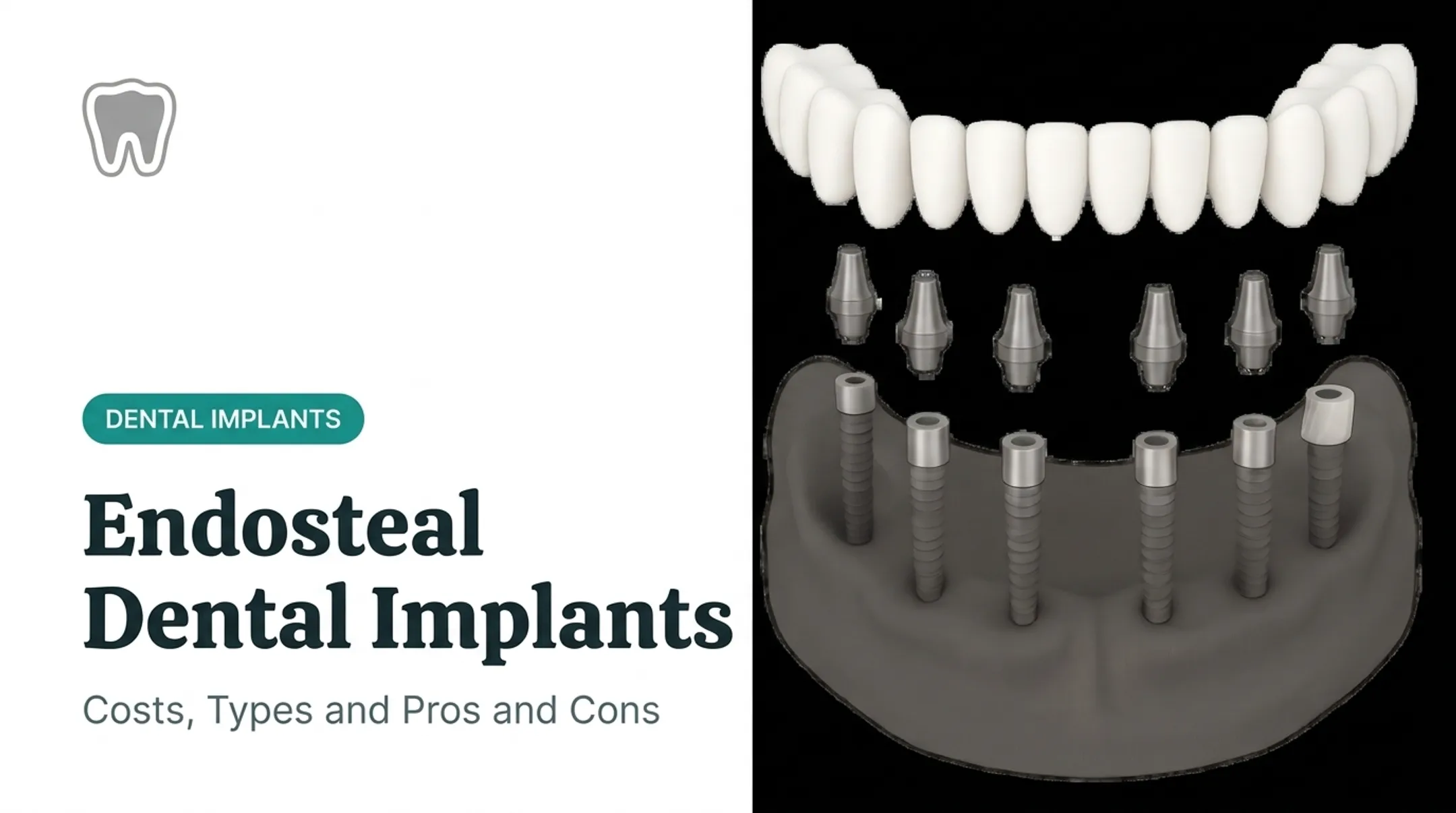Endosteal Dental Implants: Costs, Types and Pros and Cons