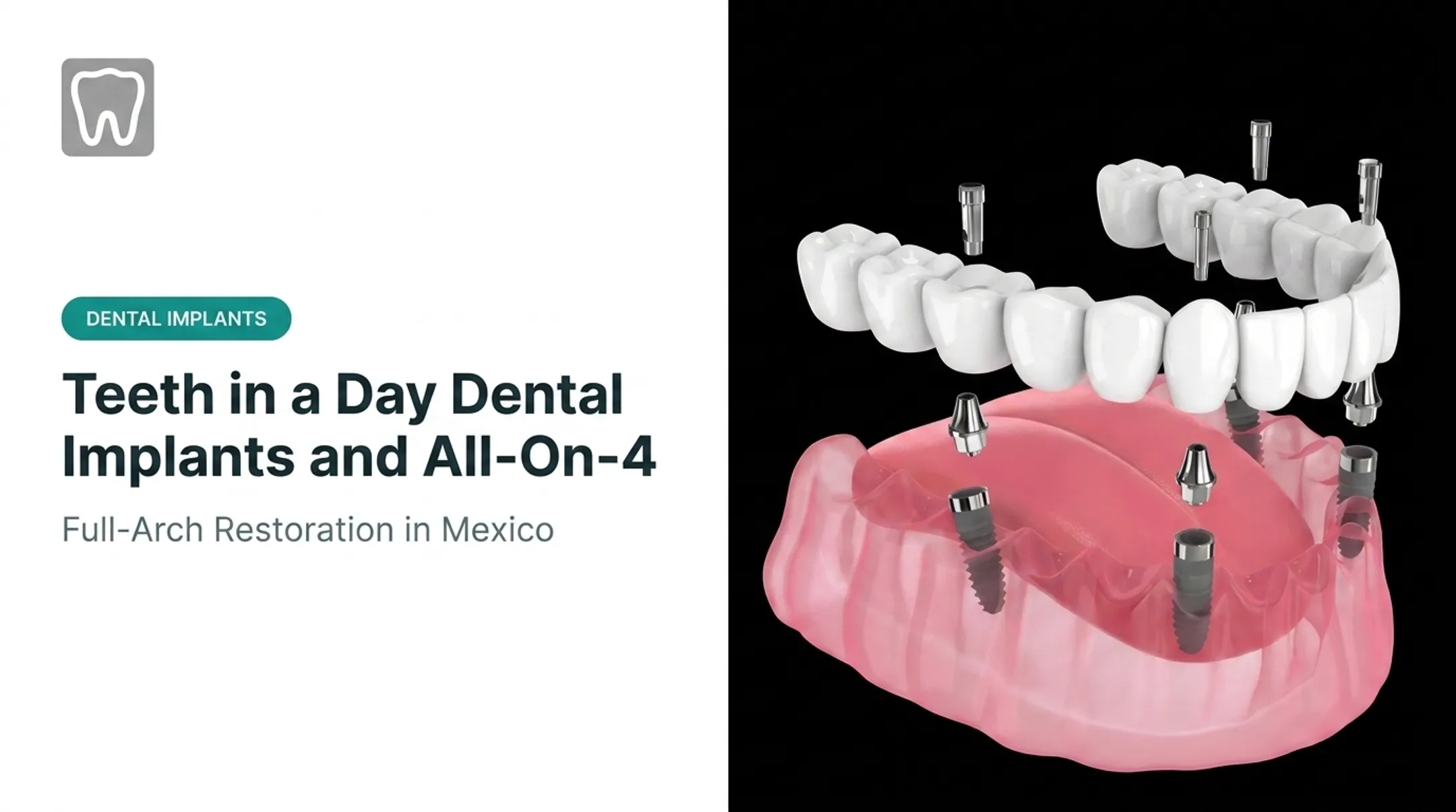 Teeth in a Day Dental Implants and All-On-4
