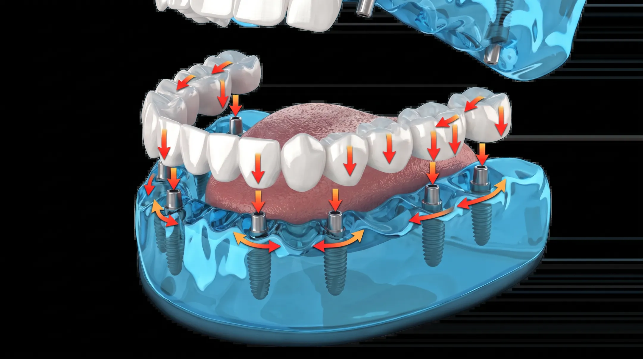 3-ON-8 protocol segmented bridge implant design diagram