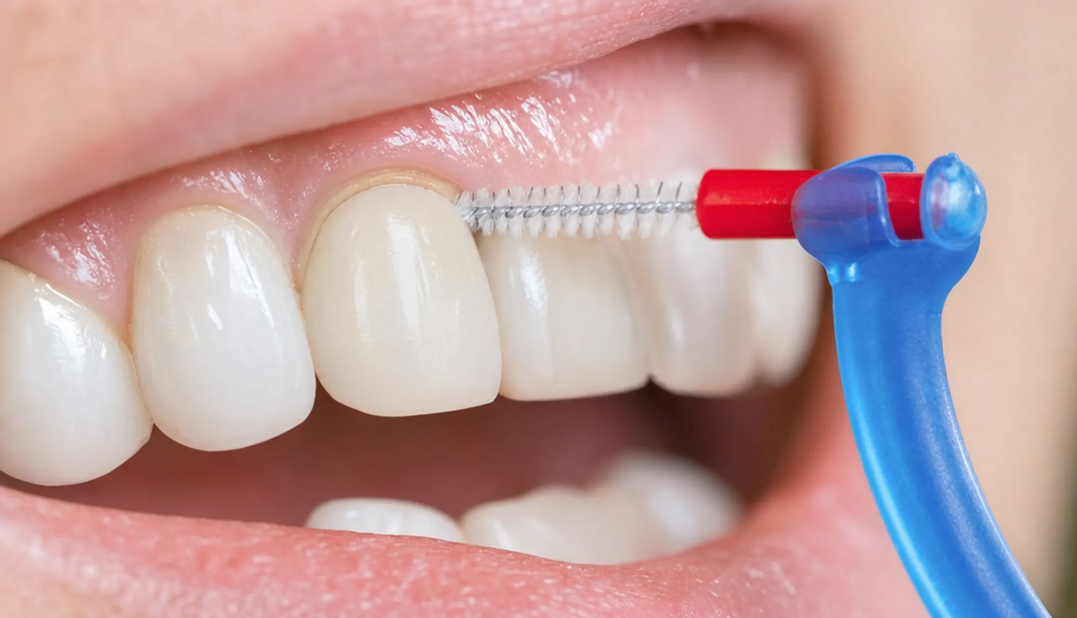 Person flossing around dental crown margins for oral hygiene maintenance