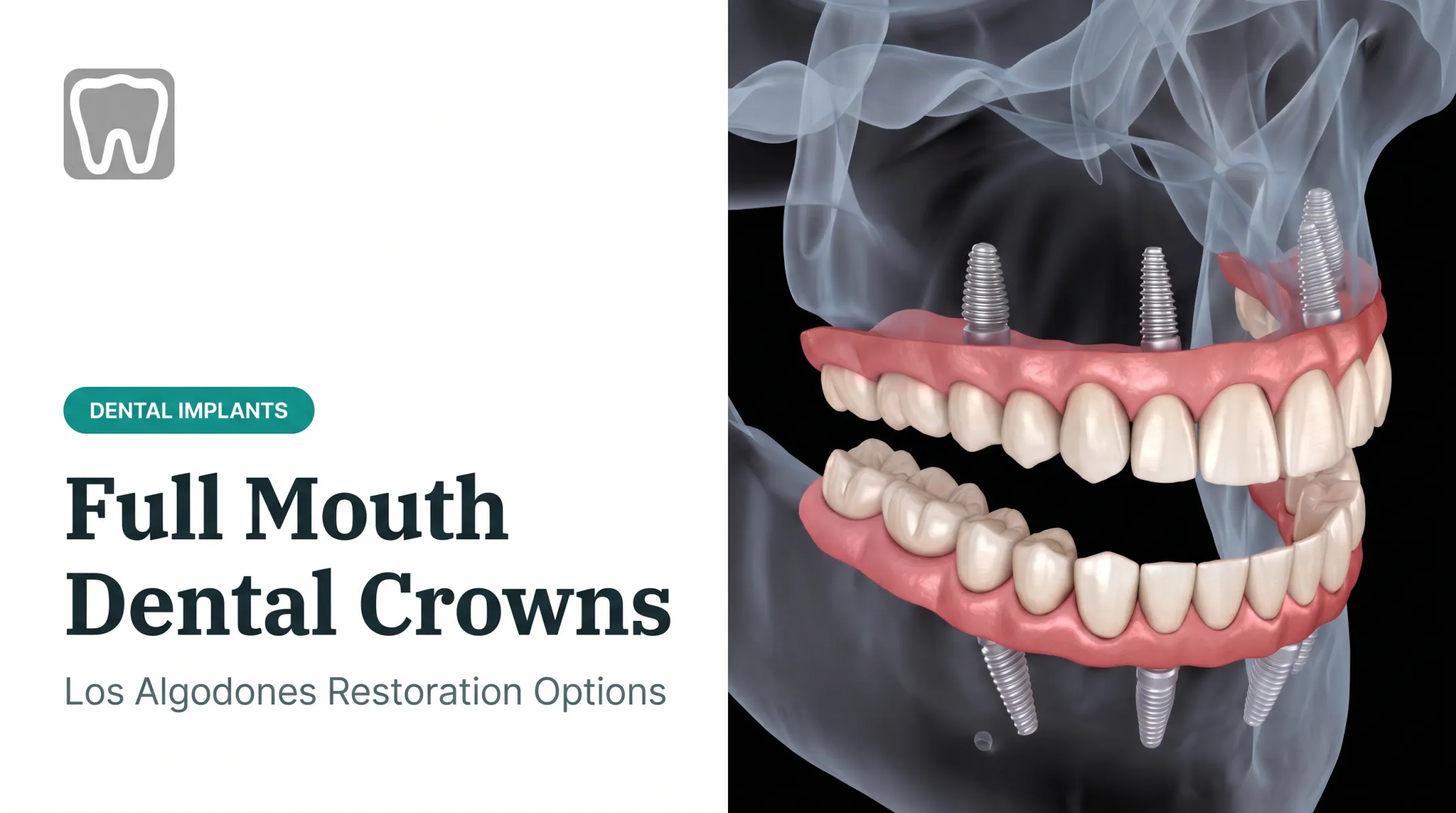 Full Mouth Dental Crowns