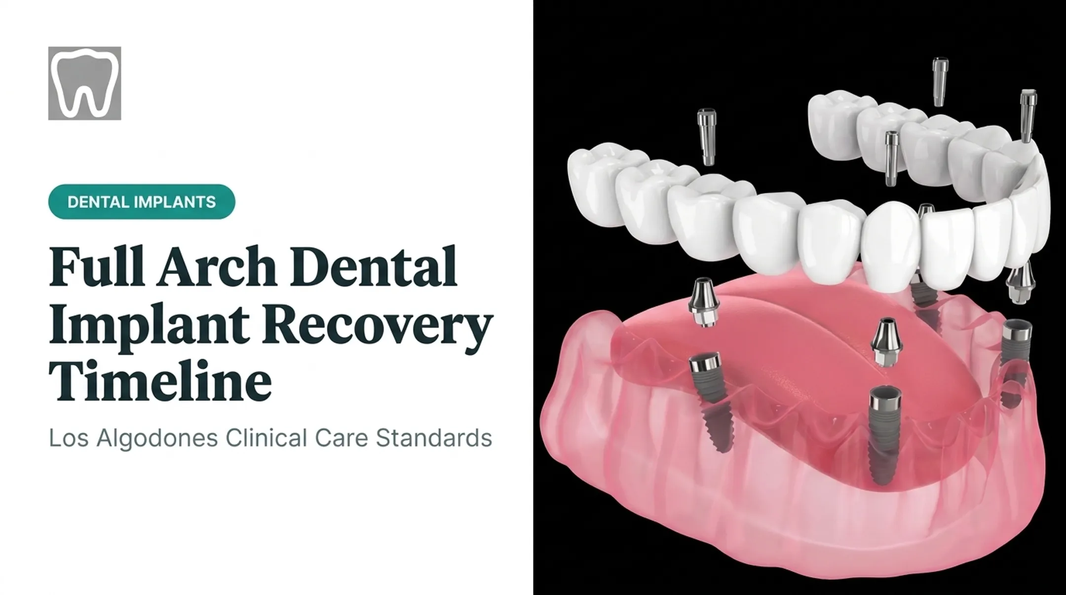 Full Arch Dental Implant Recovery Timeline